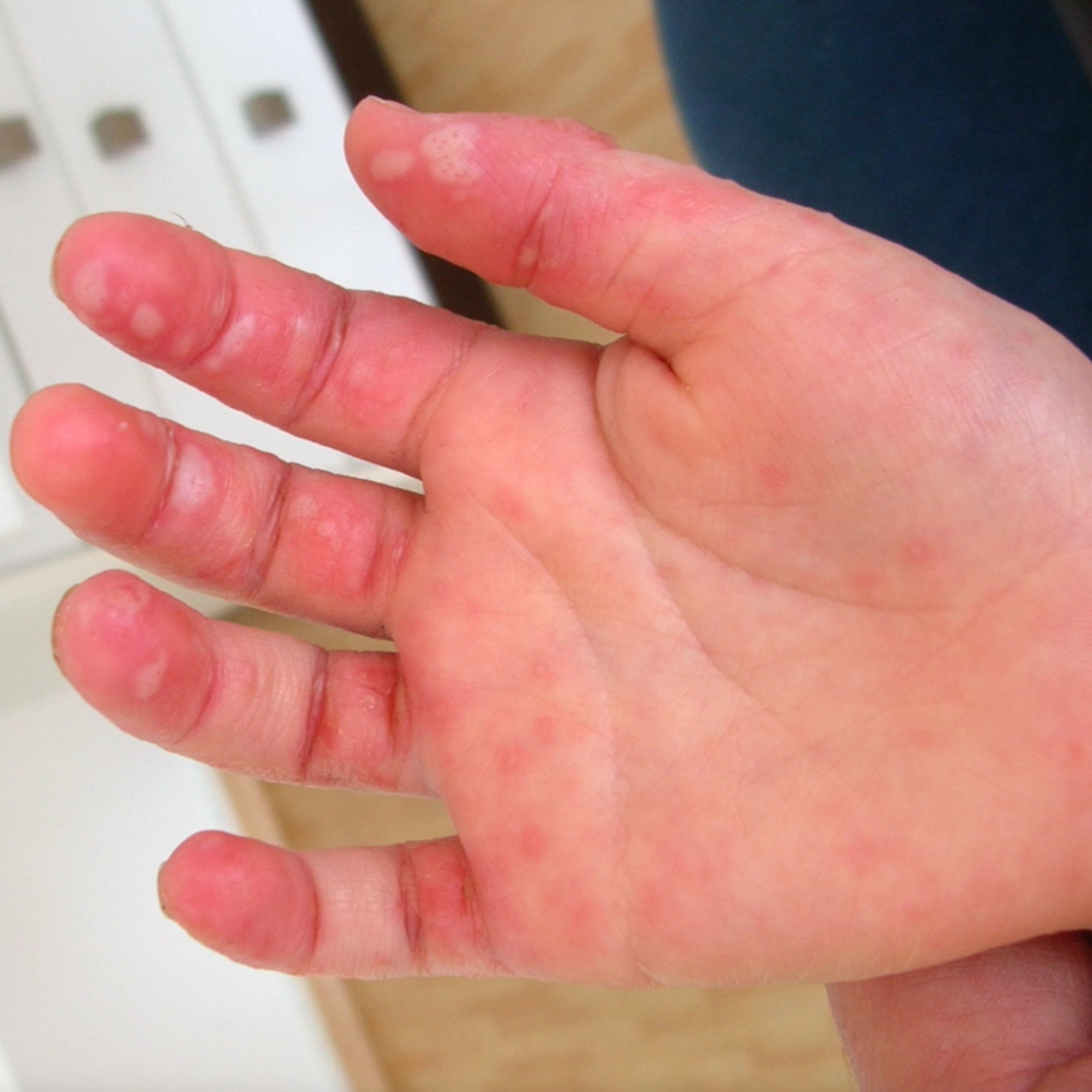 Ep 33: Hand Foot Mouth Disease episode artwork