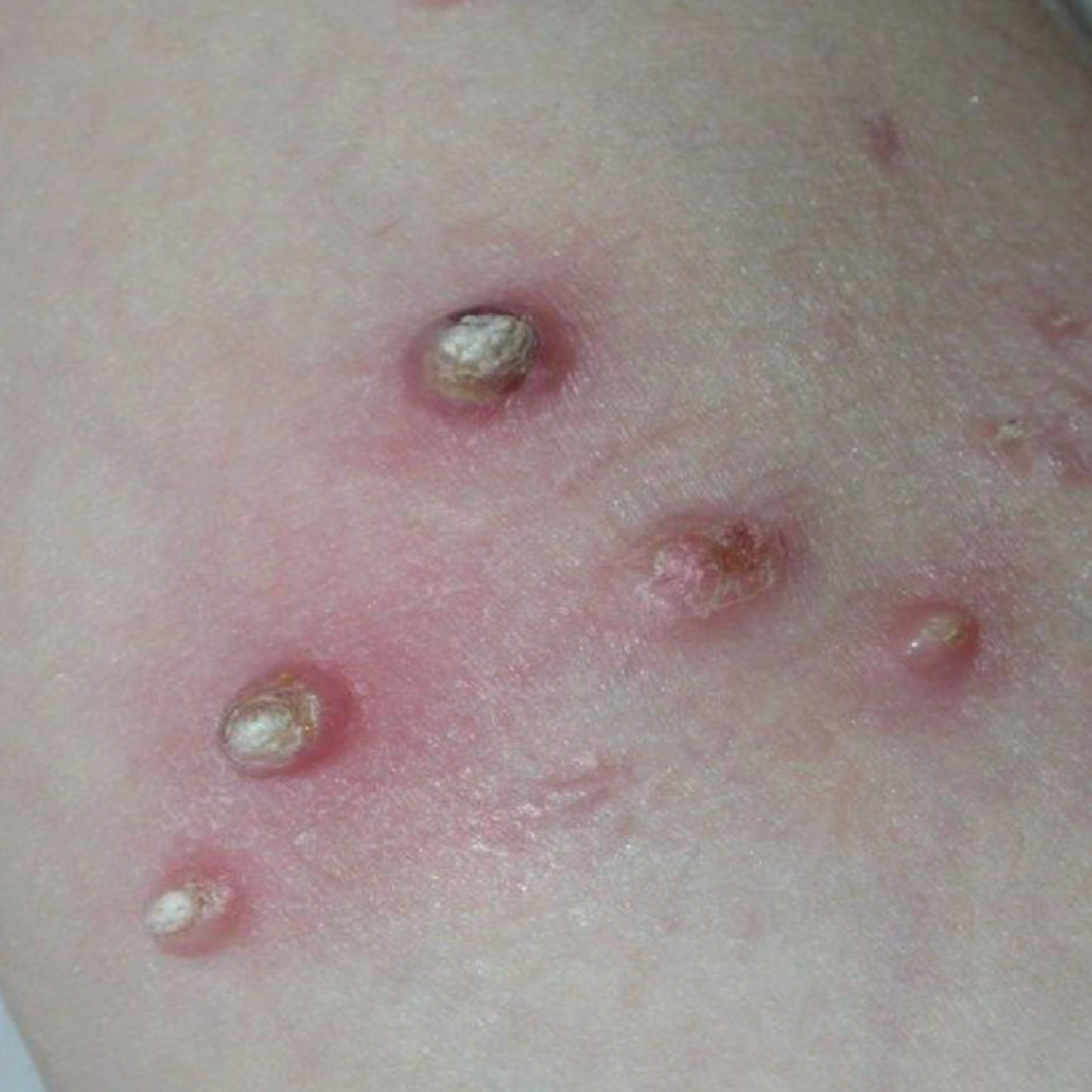 Ep 42: Molluscum Contagiosum episode artwork