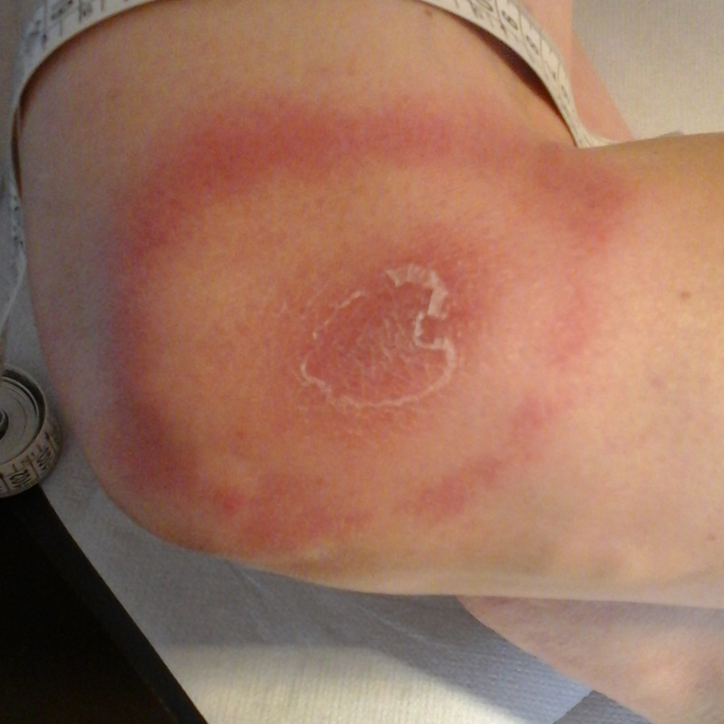 Ep 57: Lyme Disease diagnosis, treatment and prevention! episode artwork