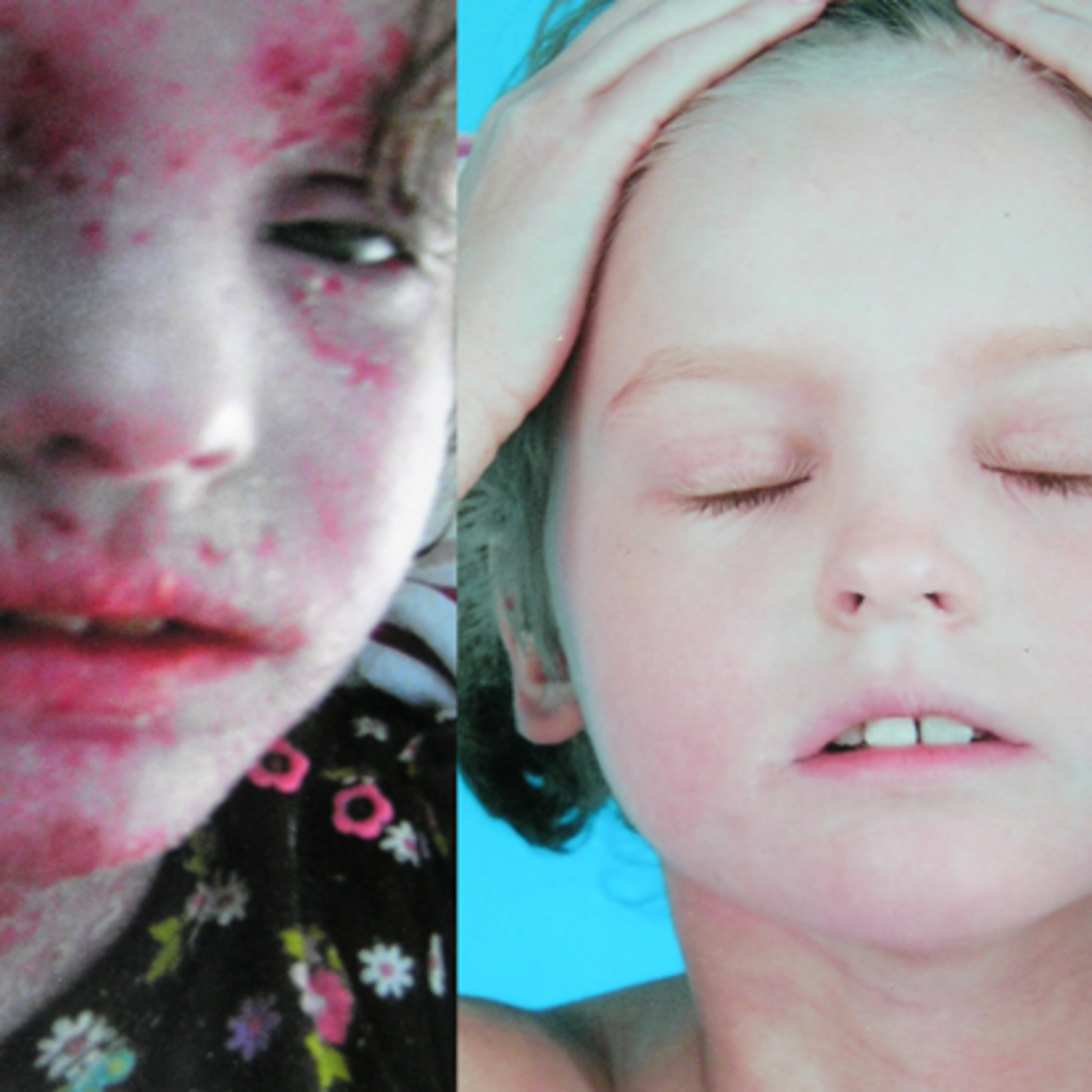 Ep 60: Eczema, Atopic Dermatitis episode artwork