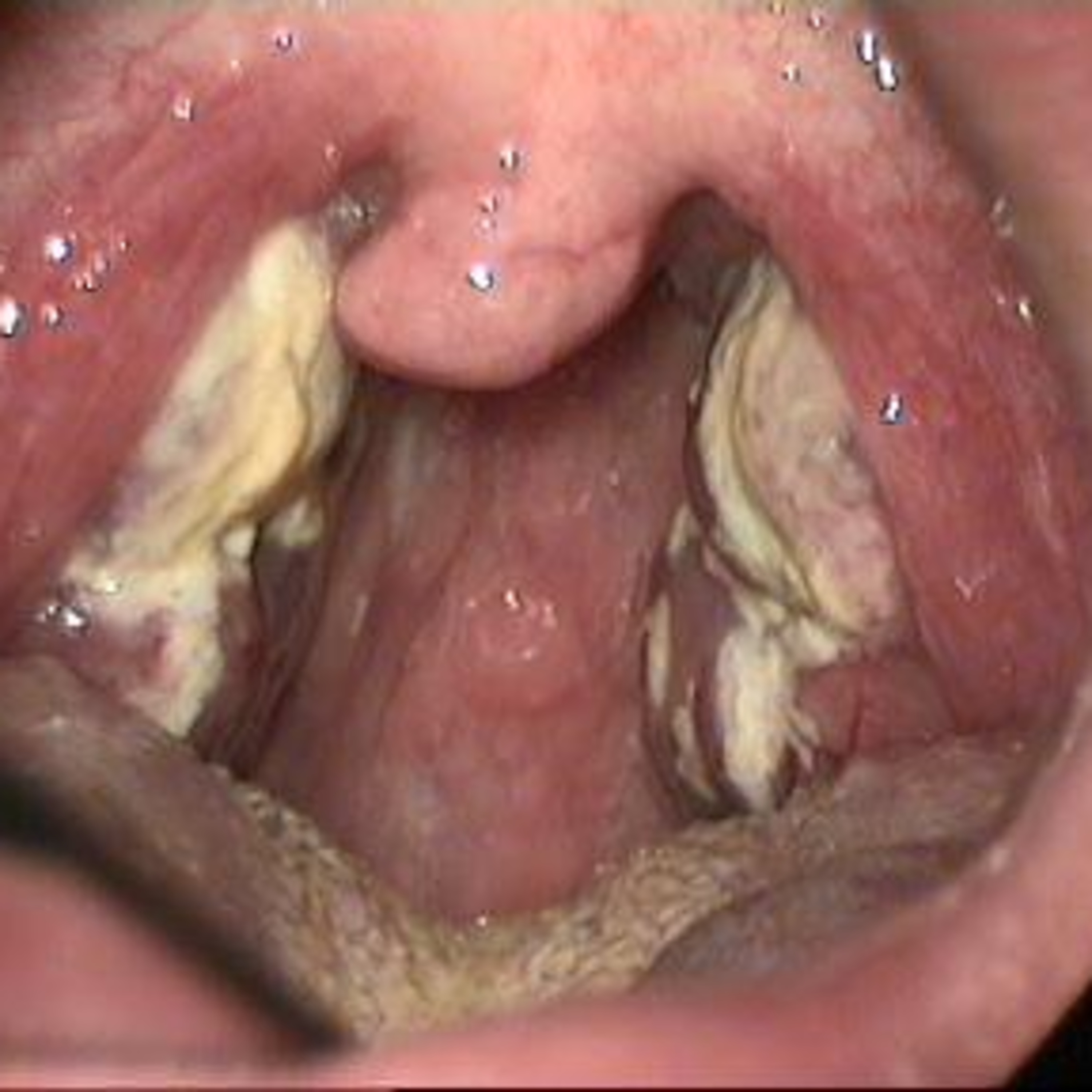 Ep 71: Mononucleosis, aka Mono or The Kissing Disease episode artwork