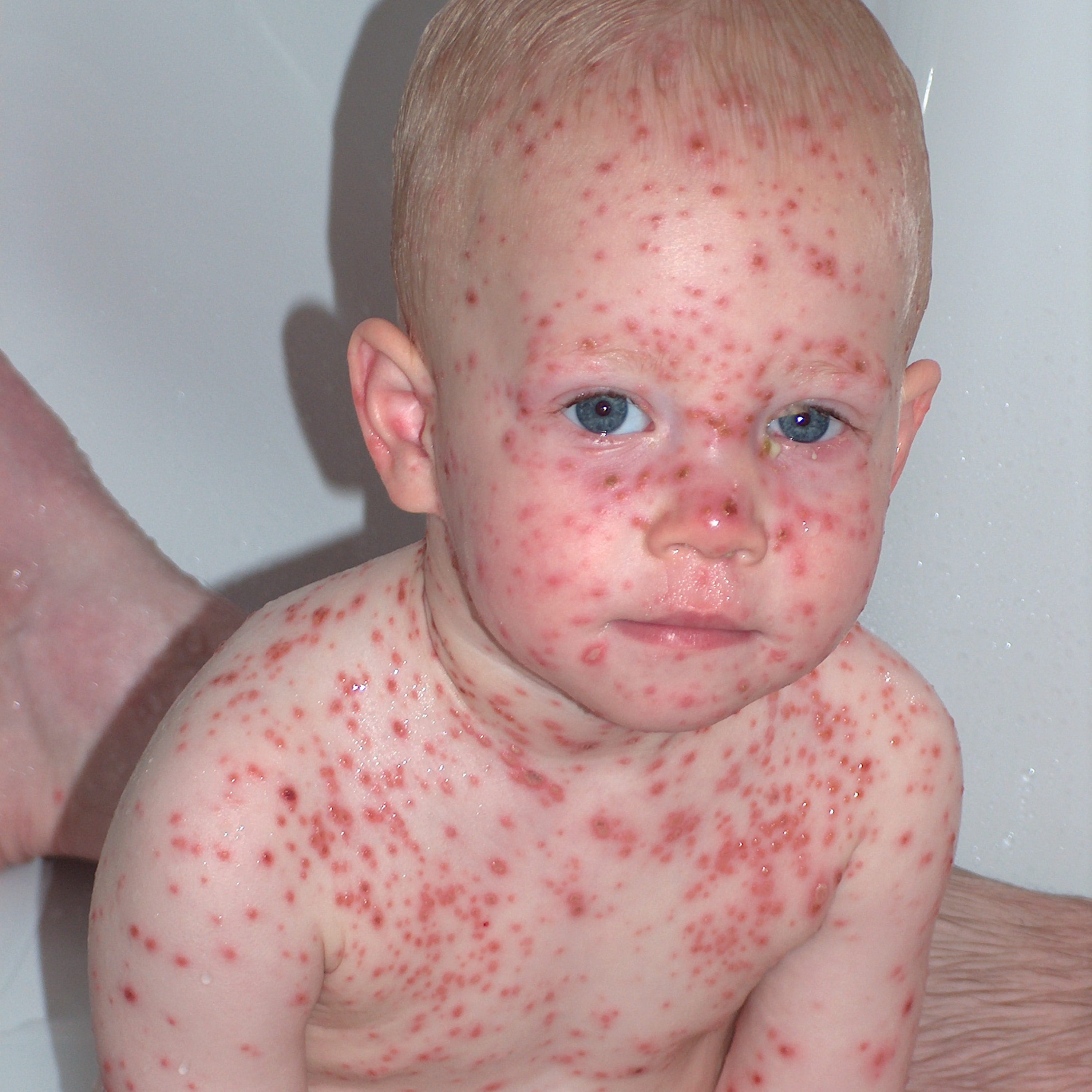 Ep 85: Chicken Pox! episode artwork