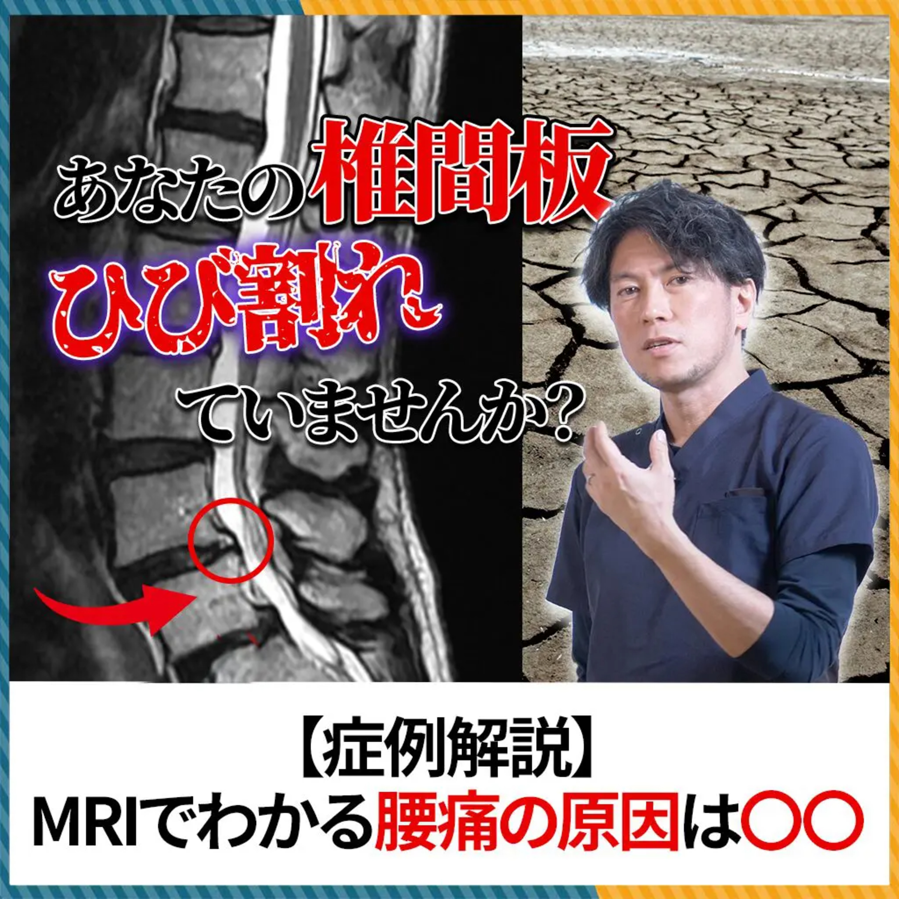 MRIで見えるひび割れは「隠れた腰痛」の原因かもしれません。実症例を紹介しながら解説！ episode artwork