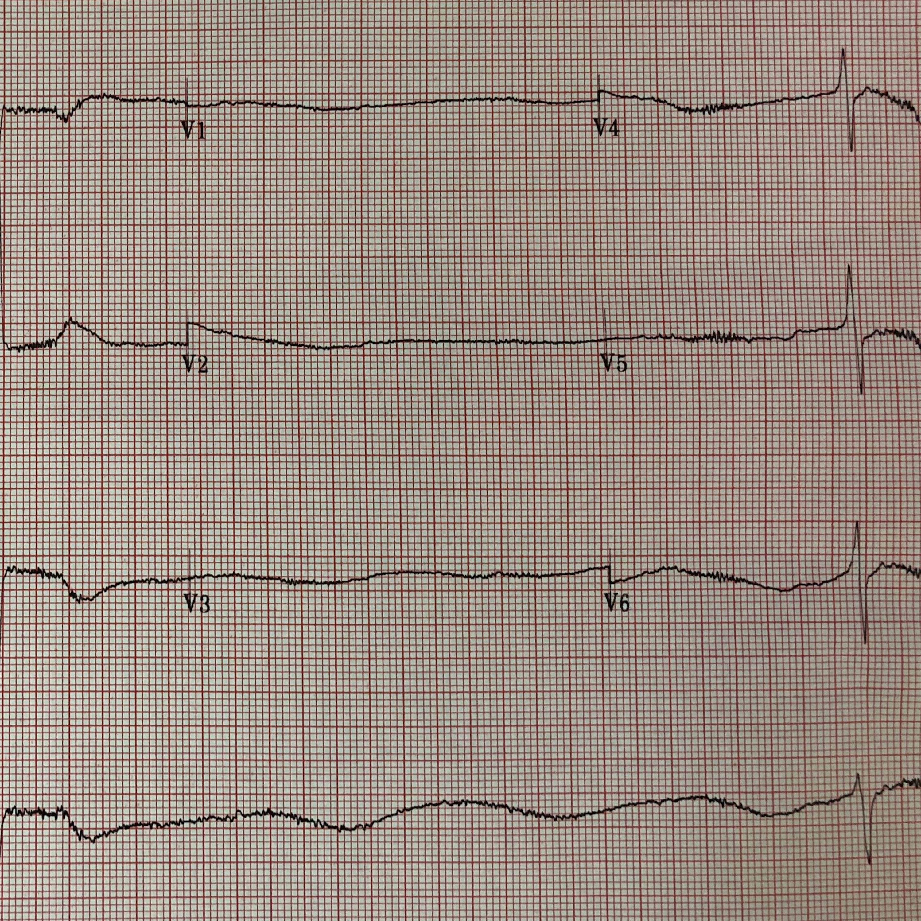 264. How to not miss a Beta Blocker Overdose in the ED