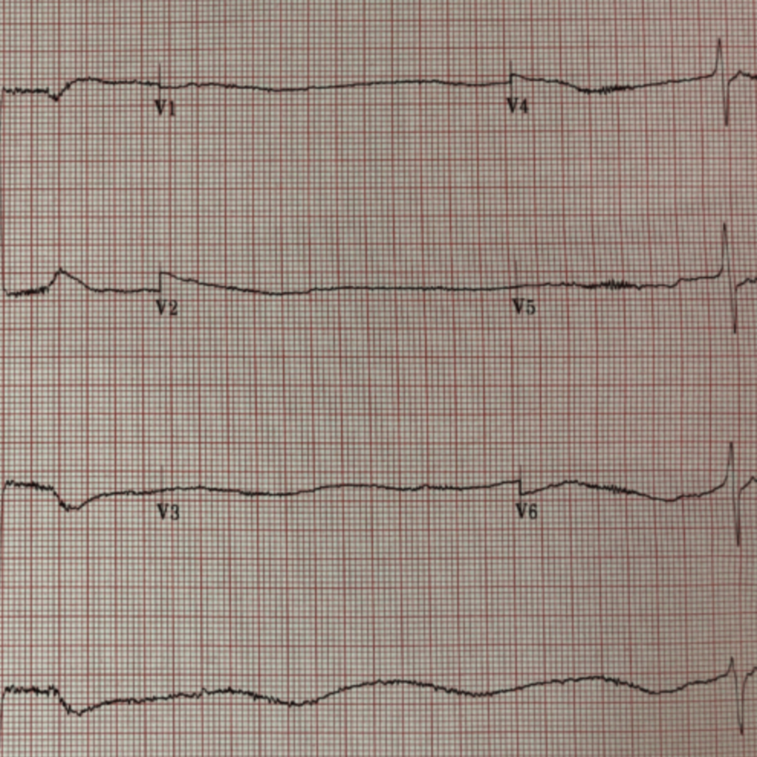265. Beta Blocker Overdose: There's only one real antidote