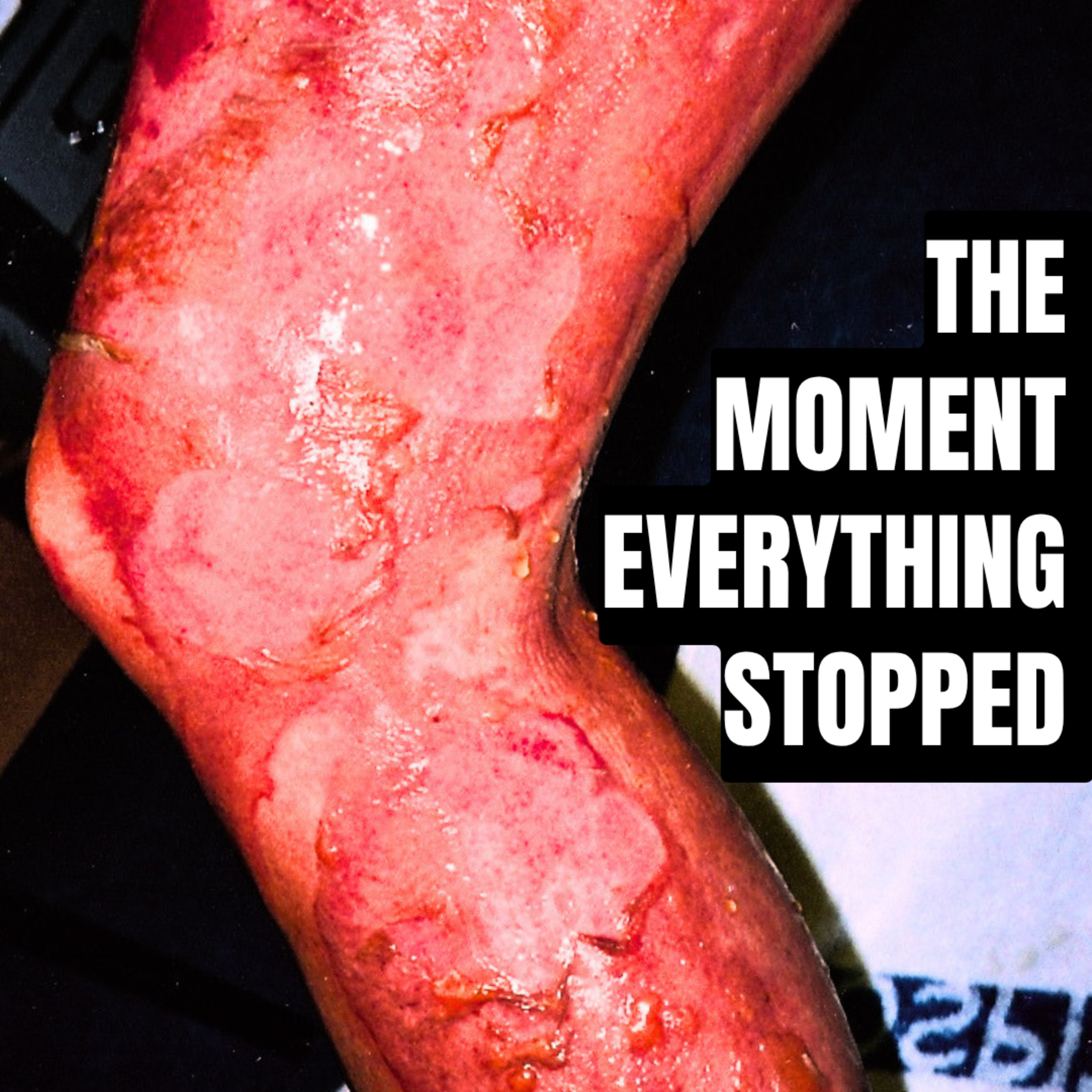 The Burn That Brought Me Back | The Accident That Stopped My Life episode artwork