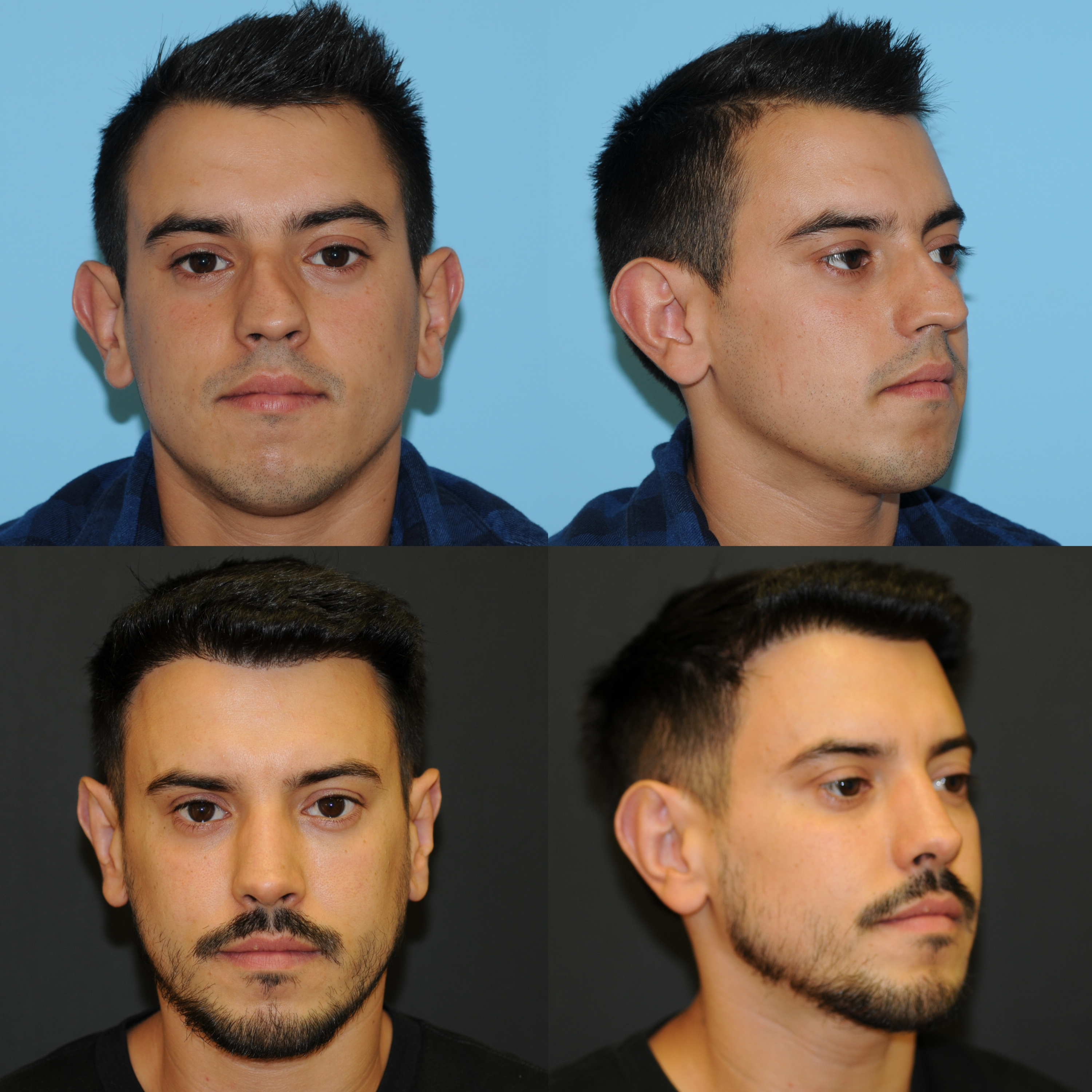 He Broke His Nose at 8 and Couldn’t Breathe Until 21 | Gonçalo’s Rhinoplasty Transformation #podcast
