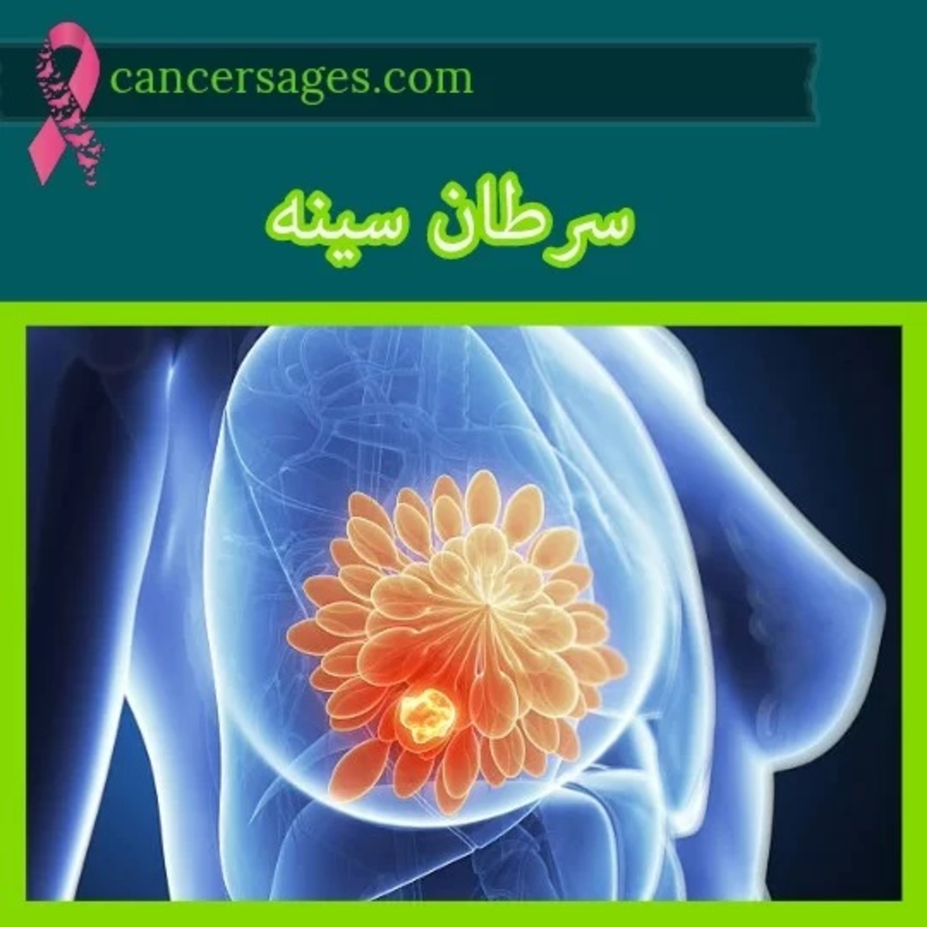 کاور سرطان سینه یا سرطان پستان آنچه باید بدانید- کنسرسیج