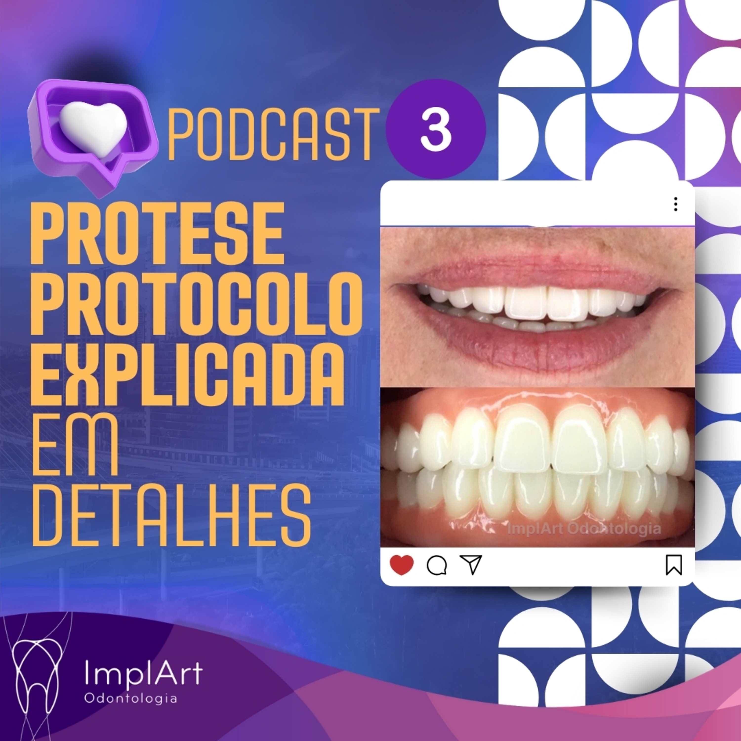 IMPLANTE DENTÁRIO PODCAST - Clínica ImplArt - Sorriso Digital e Implantes Dentários com Tecnologia