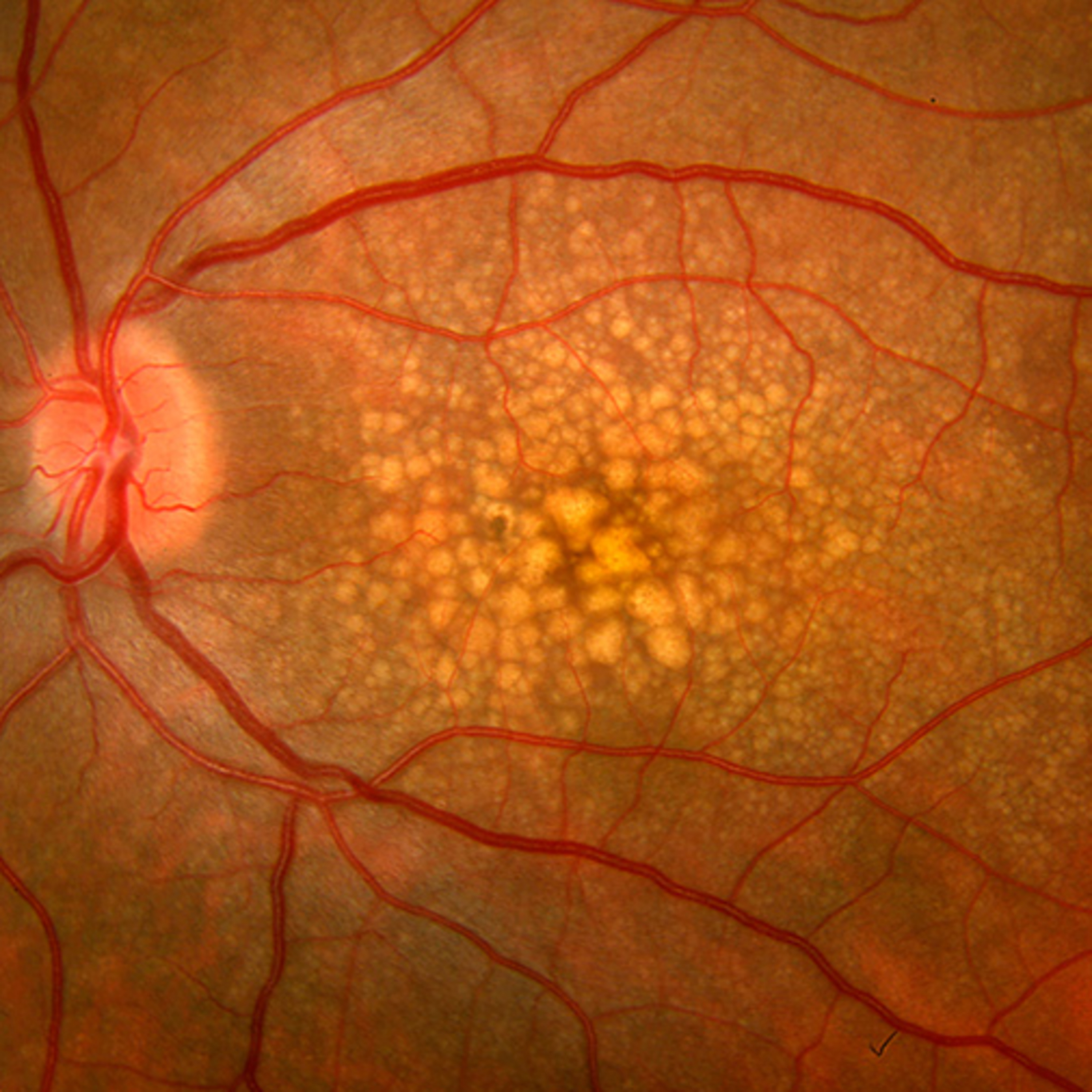Retina e Oftalmo Podcast