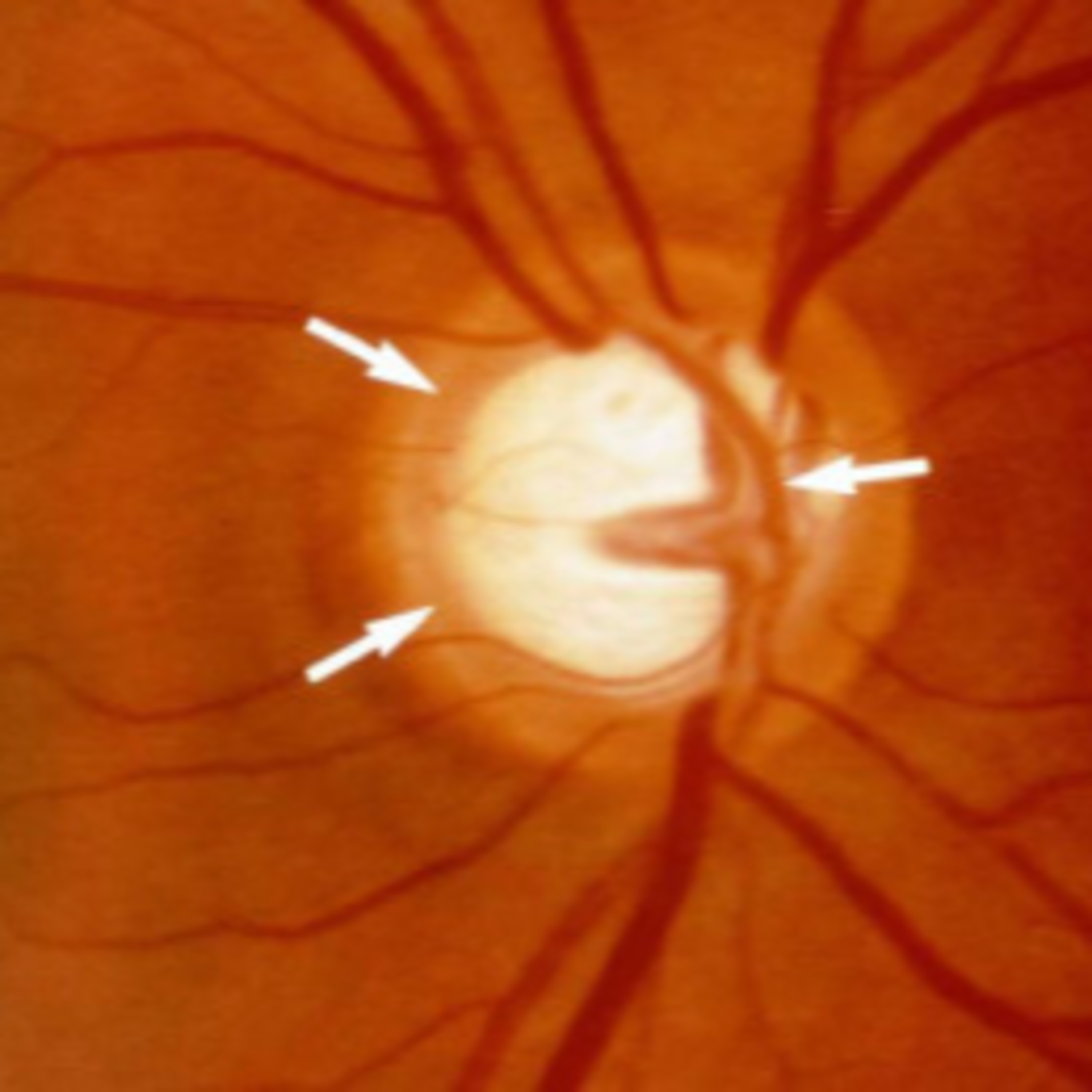 Retina e Oftalmo Podcast
