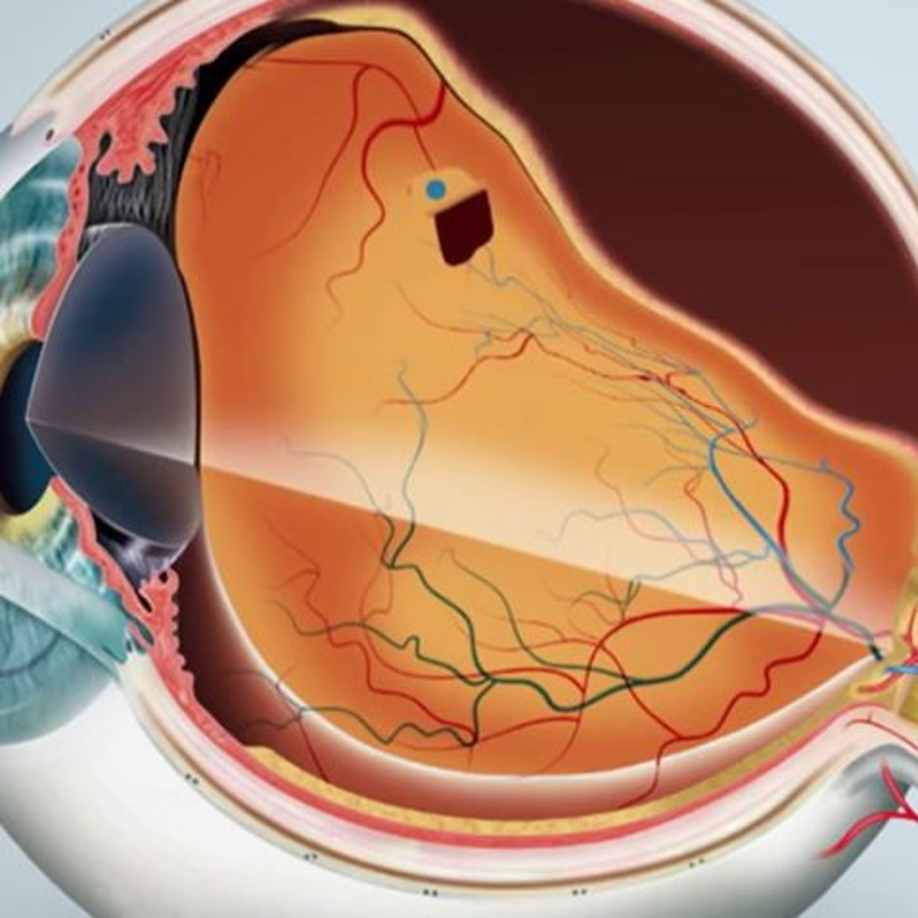 Retina e Oftalmo Podcast