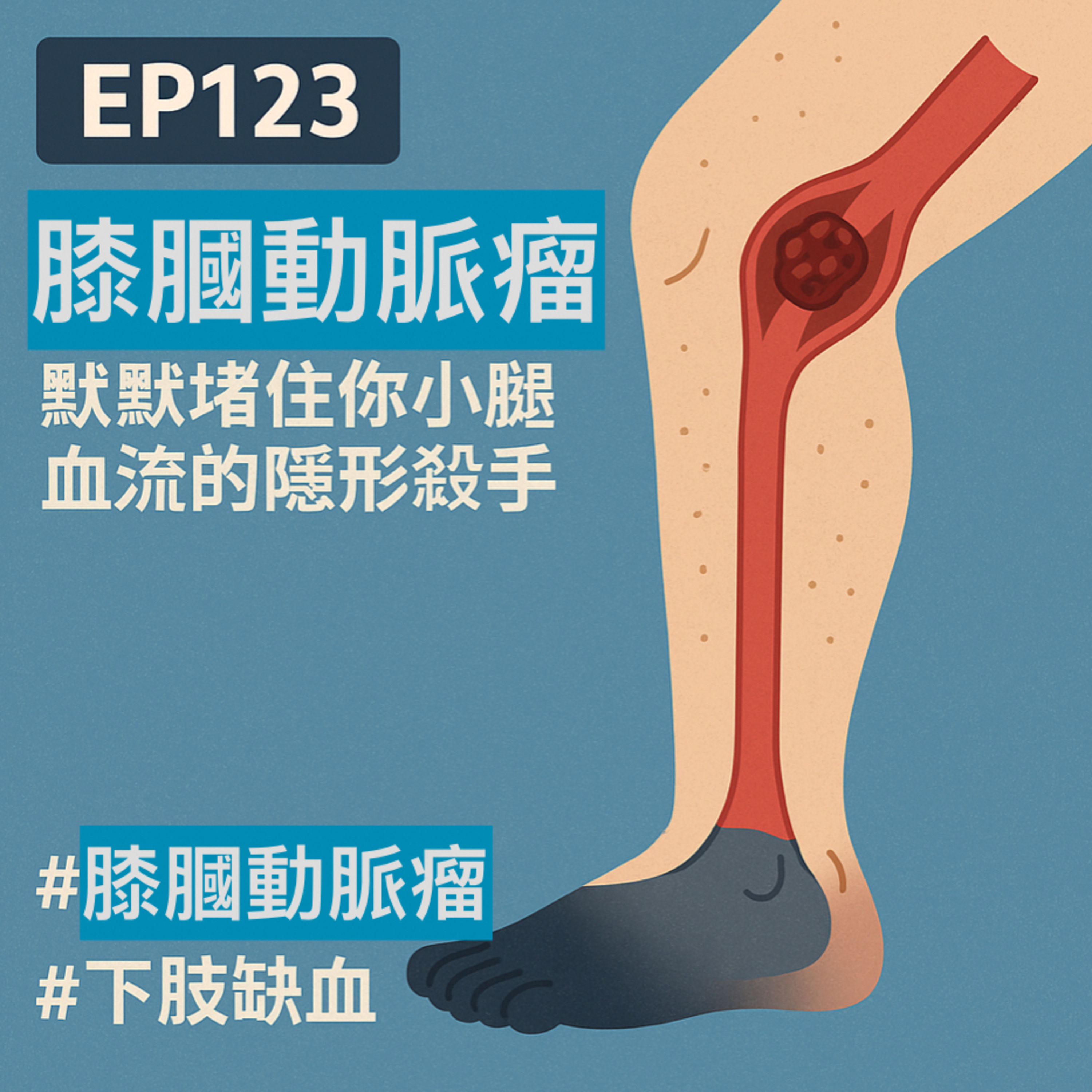 🎙️EP123｜膝蓋後面的炸彈？膕動脈瘤：默默堵住你小腿血流的隱形殺手