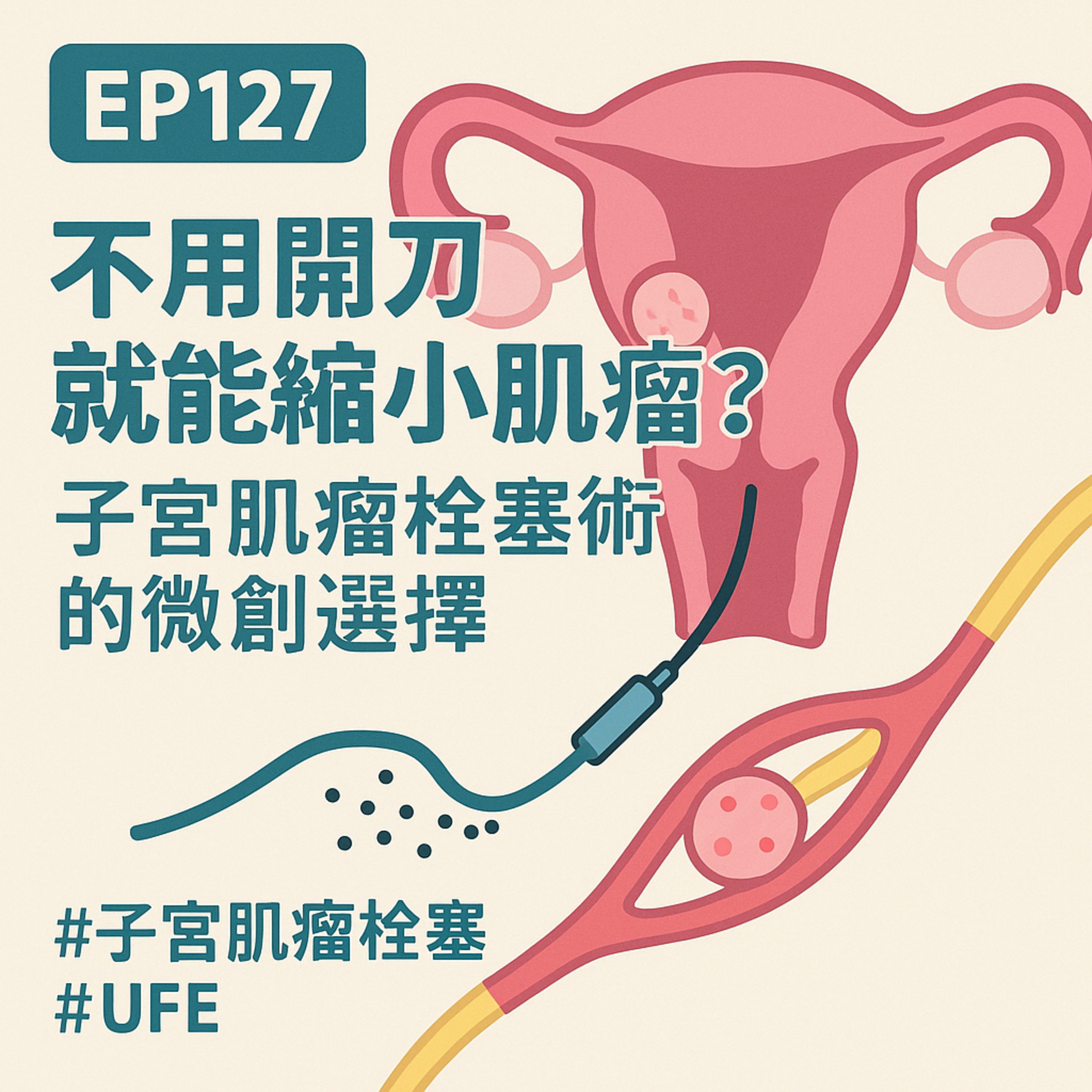 🎙️EP127｜不用開刀就能縮小肌瘤？子宮肌瘤栓塞術的微創治療選擇