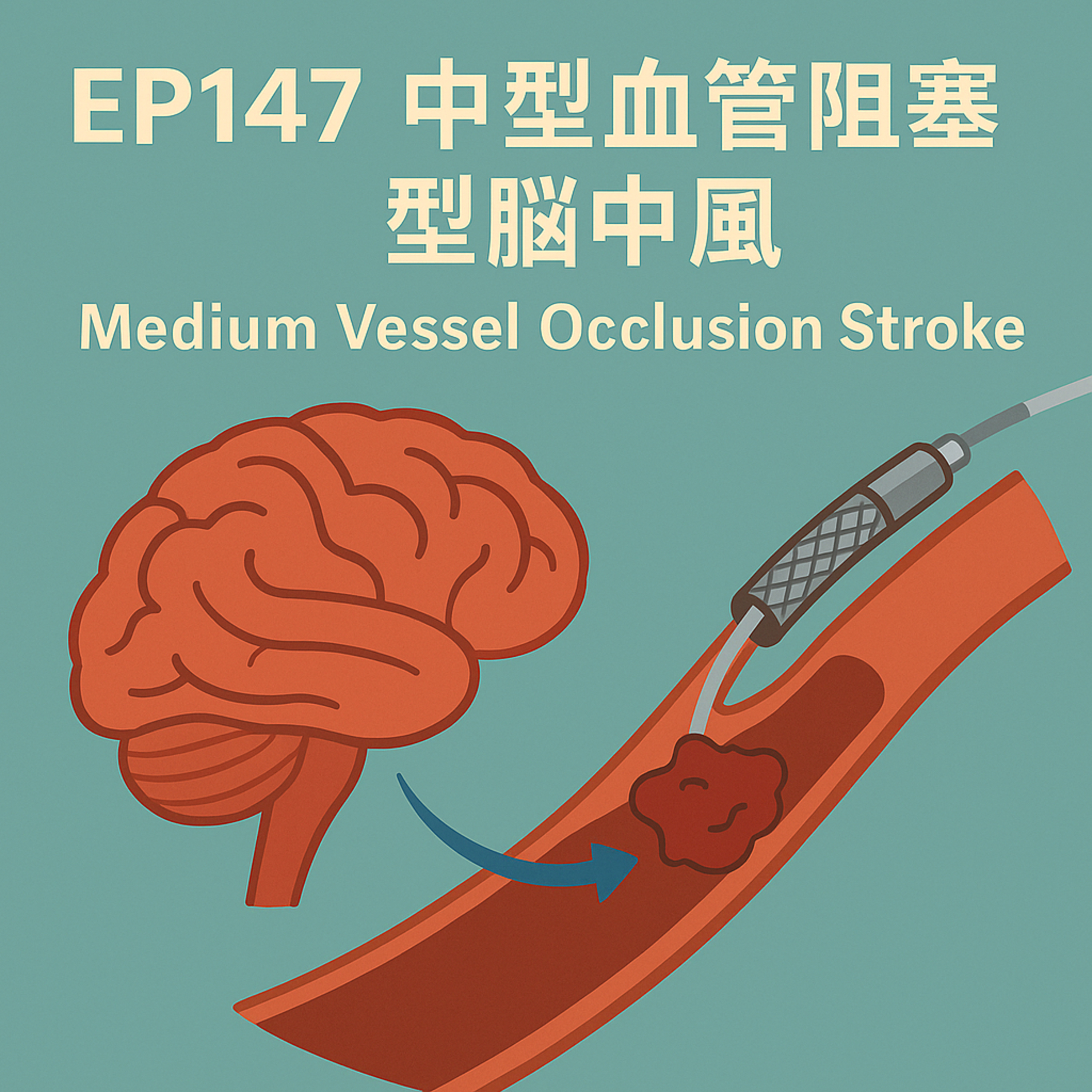 🎙️EP147｜中風不是越快處理越好？中小型血管栓塞（MeVO）取栓的爭議與挑戰