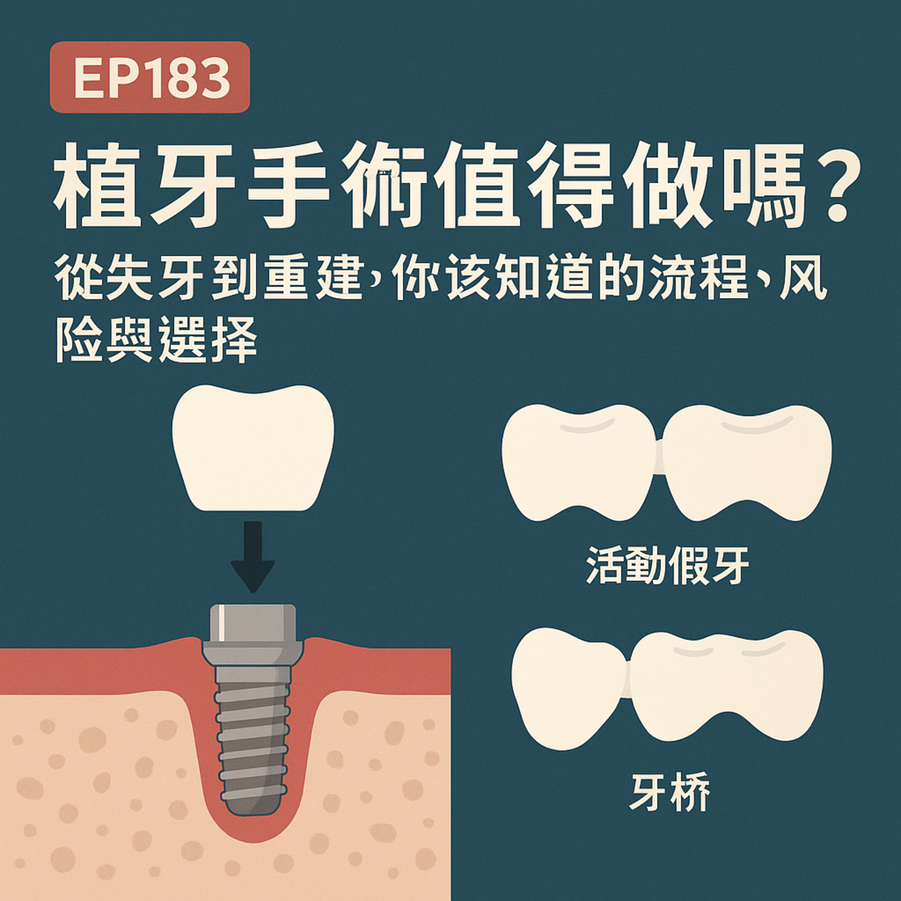 🎙️EP183｜植牙手術值得做嗎？從失牙到重建，你該知道的流程、風險與選擇