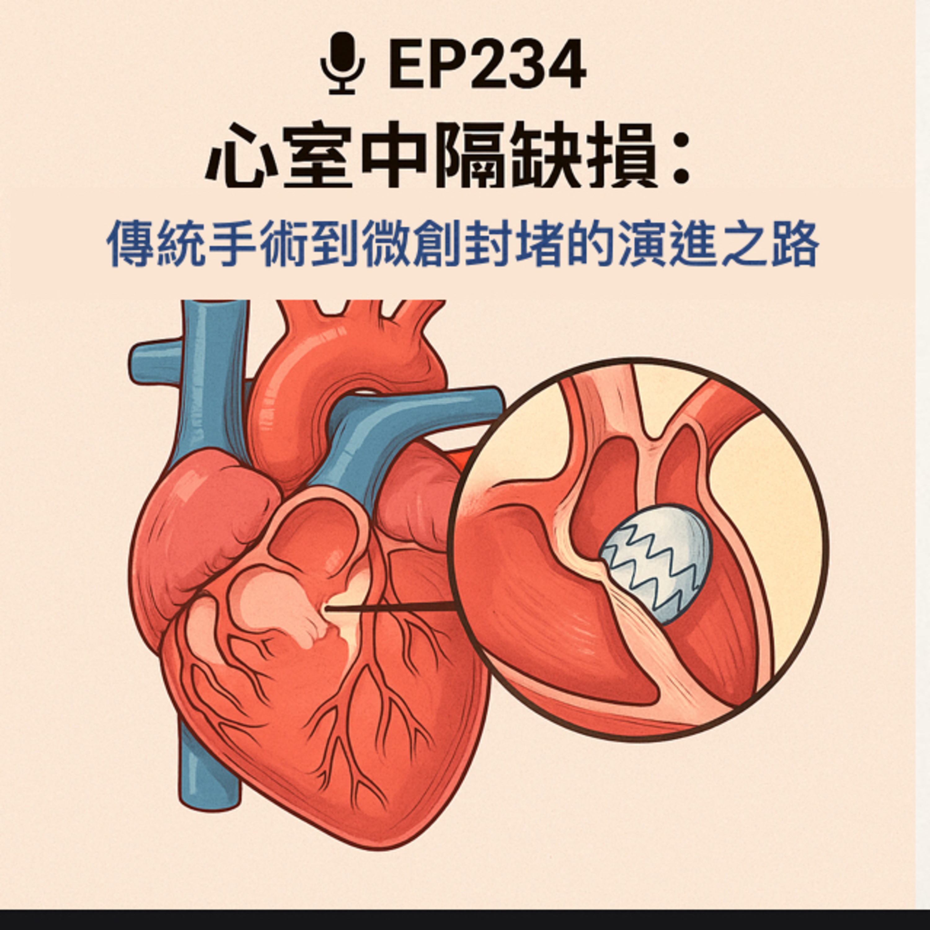 🎙️EP234｜心室中膈缺損（VSD）：從傳統外科到微創封堵的演進與未來