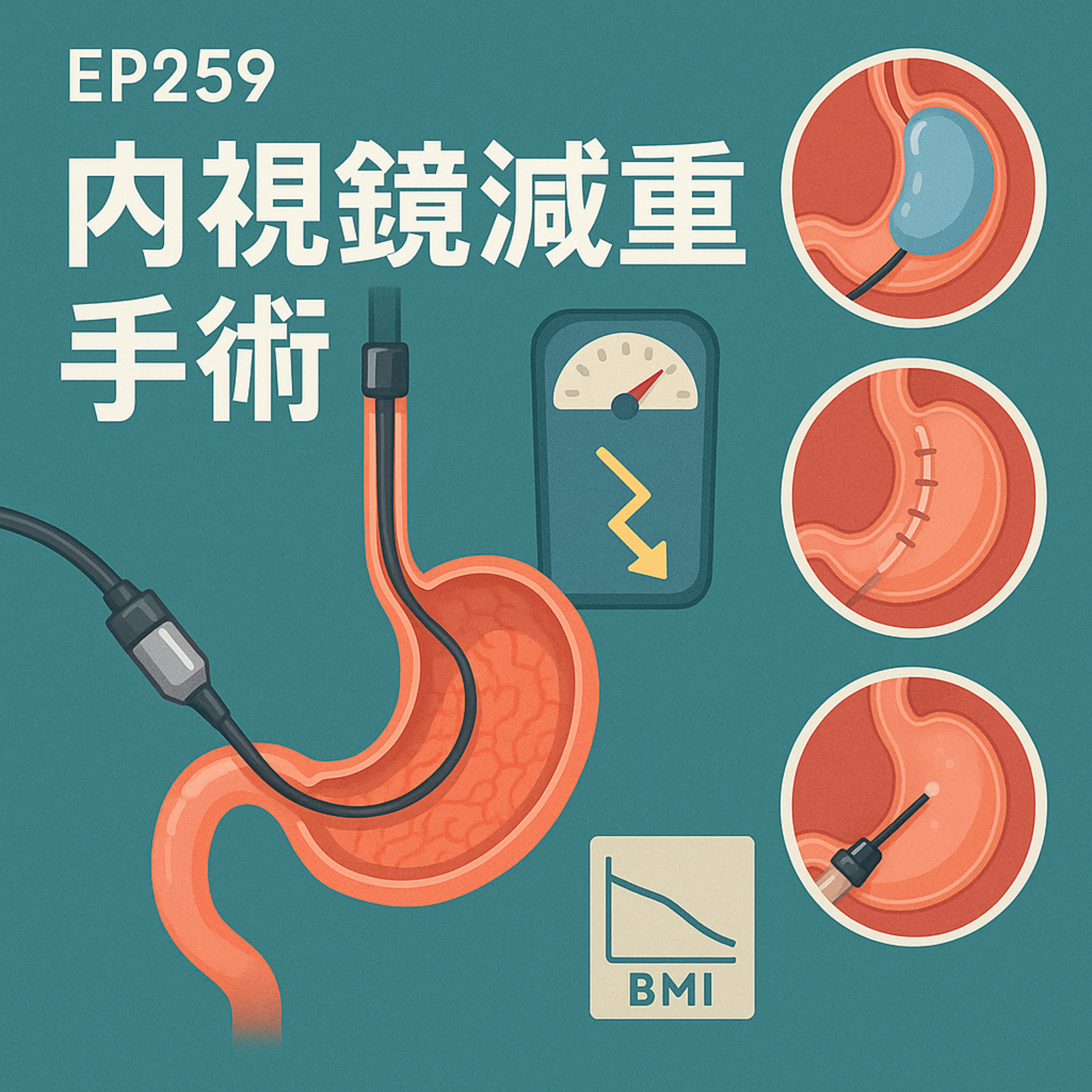 🎙️EP259｜內視鏡減重手術全攻略：胃內注射、水球與袖狀胃的比較與選擇指南