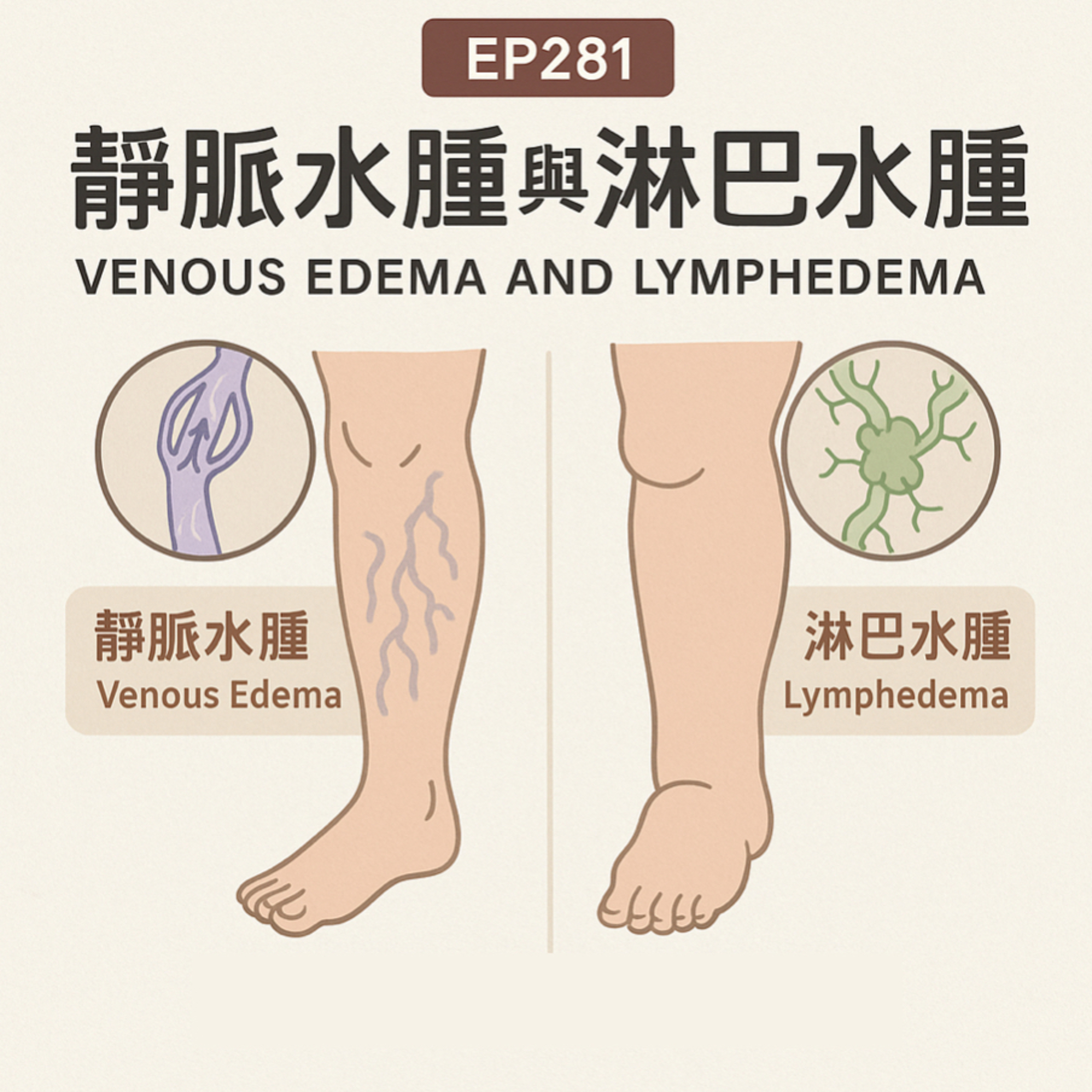 🎙️EP281｜靜脈水腫與淋巴水腫：從鑑別診斷到臨床管理的全方位解析
