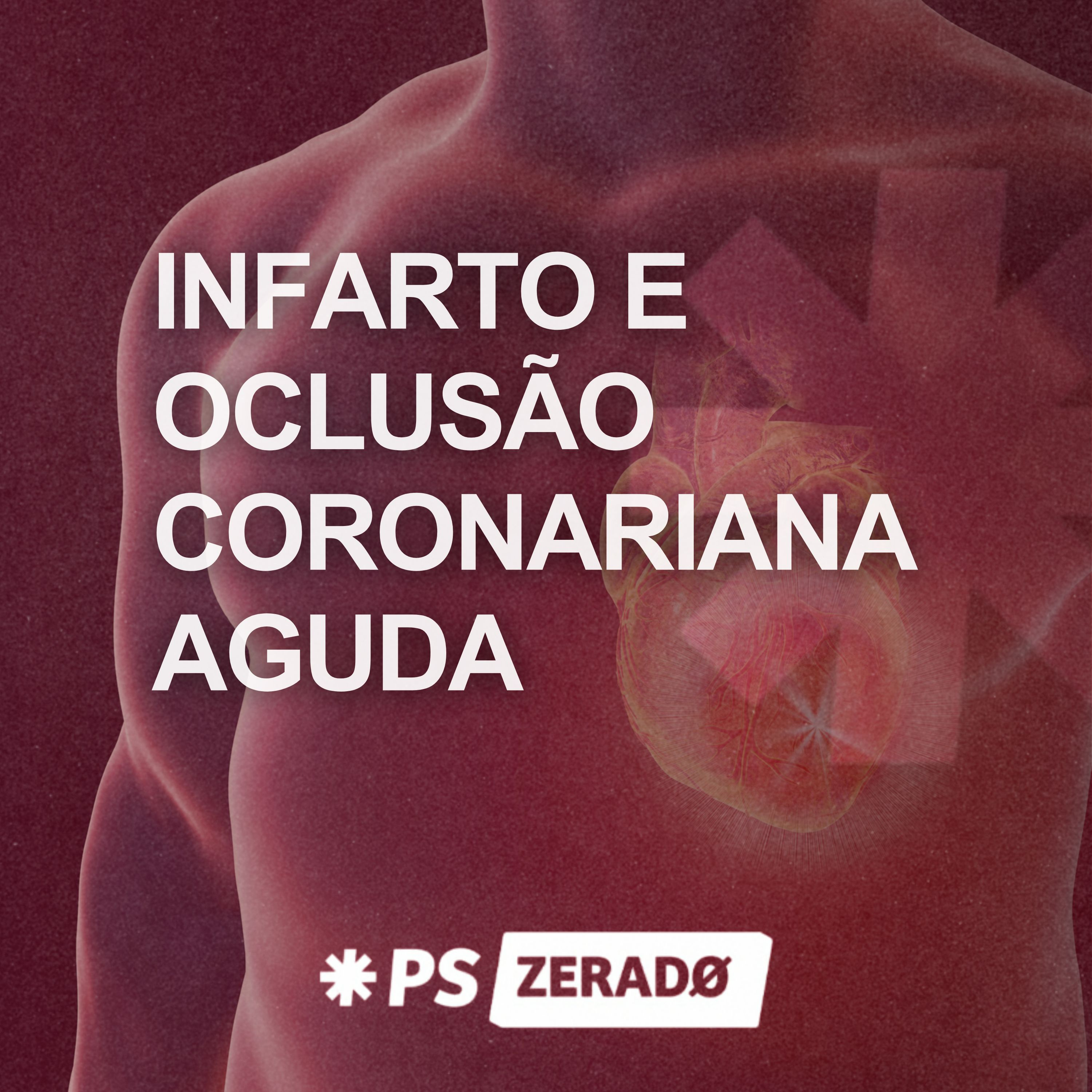 INFARTO e OCLUSÃO CORONARIANA AGUDA (OCA): o que você precisa saber  episode artwork
