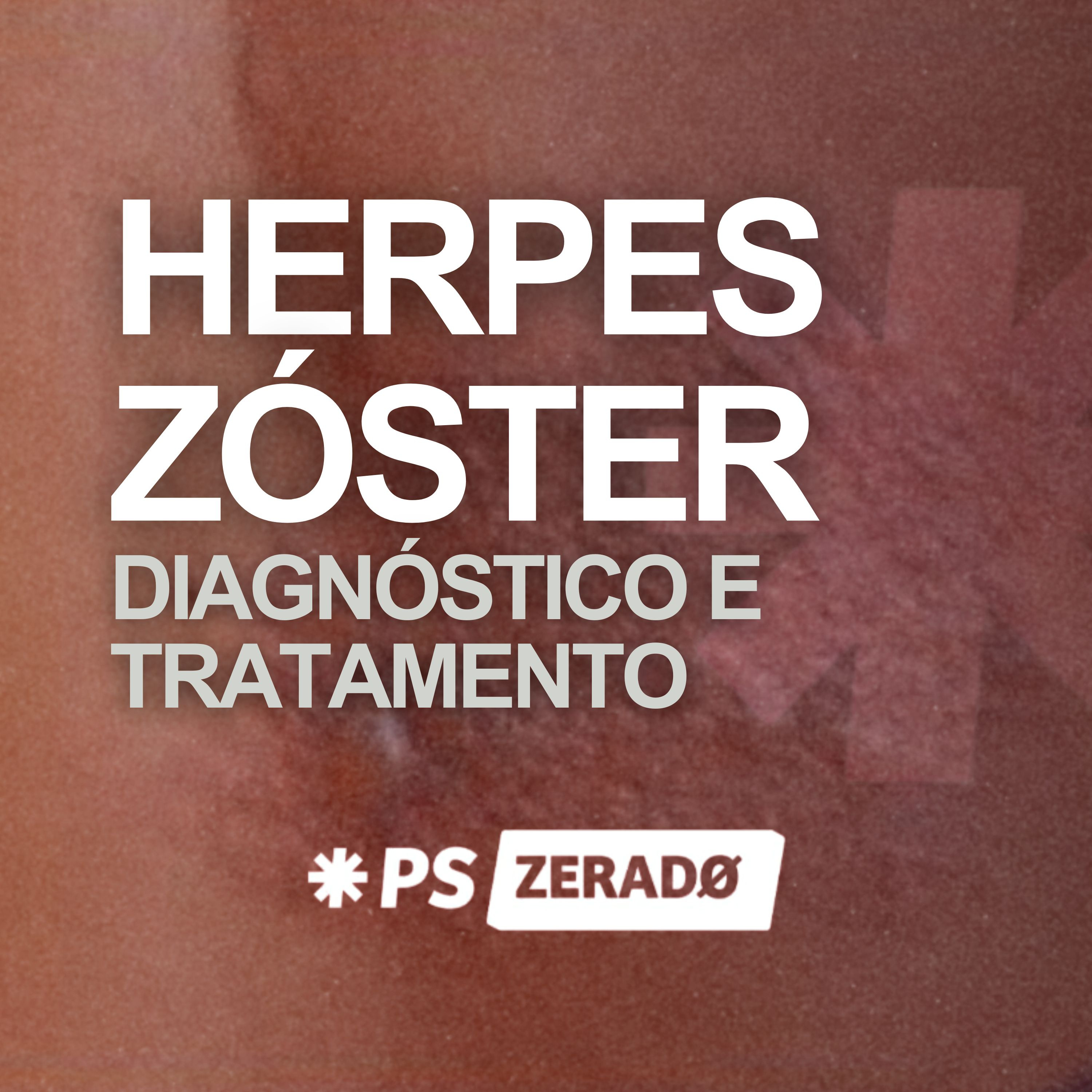 Herpes Zóster: diagnóstico rápido e tratamento correto episode artwork