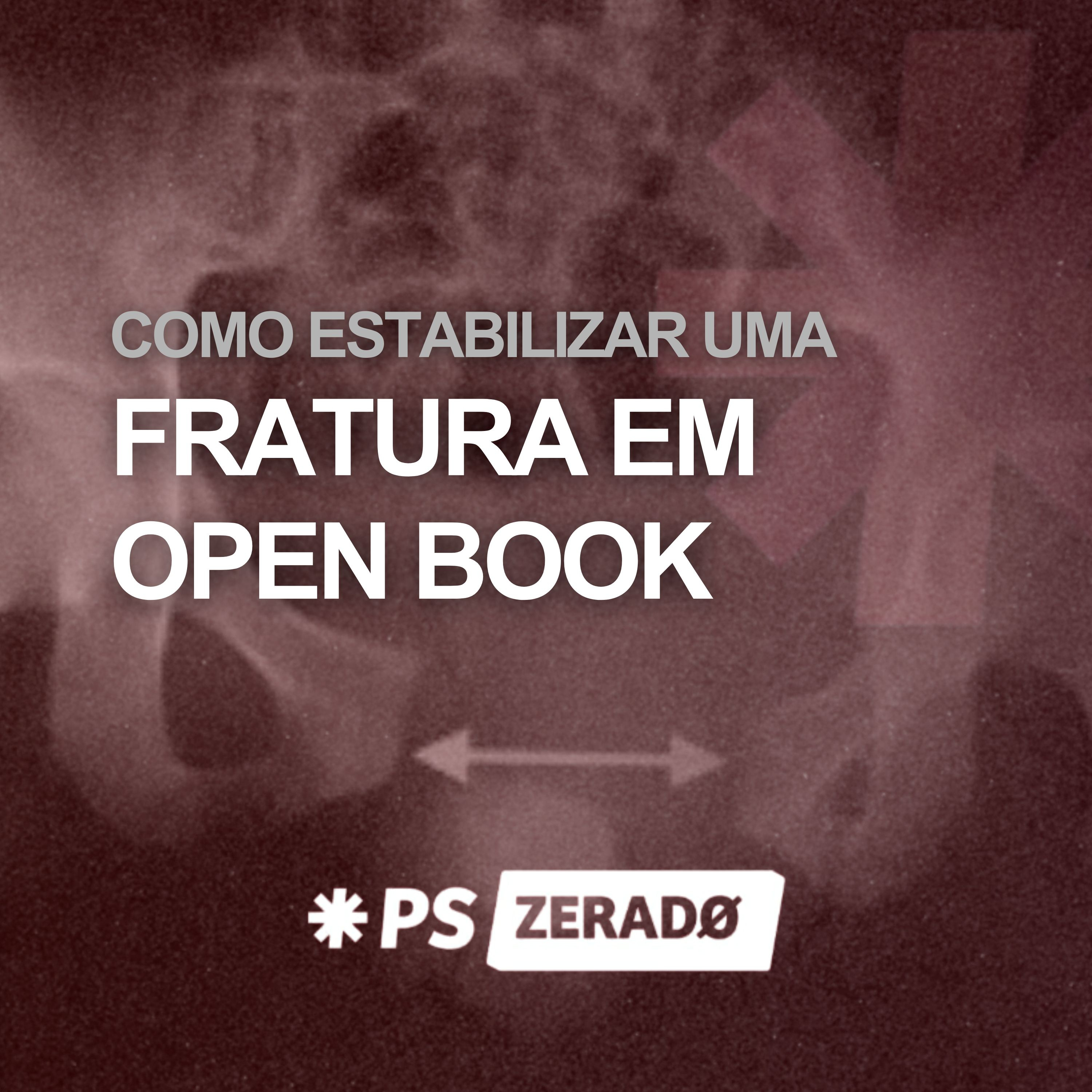 Fratura em open book chegou no PS. O que você faz agora? episode artwork