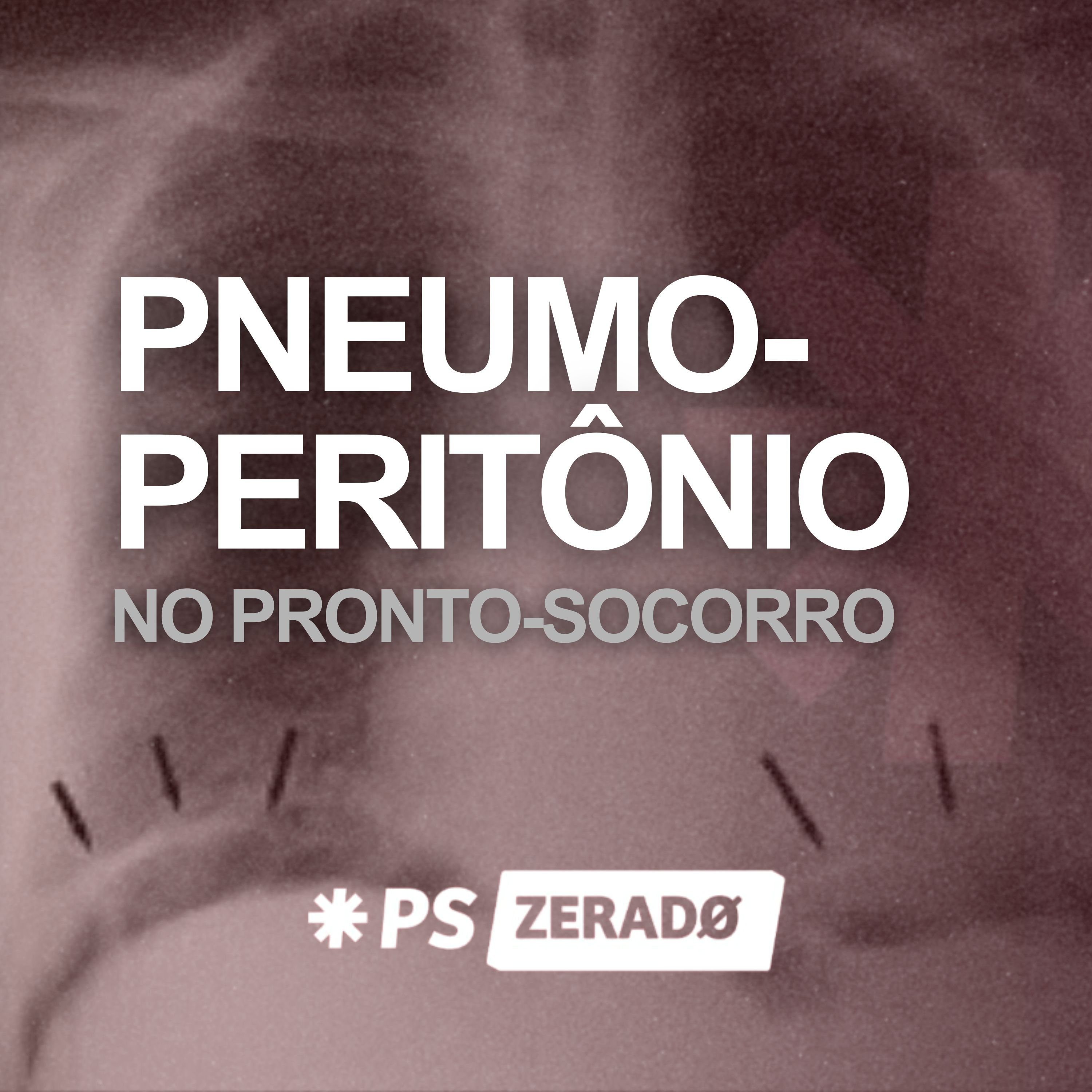 Pneumoperitônio: 2 horas para salvar uma vida episode artwork