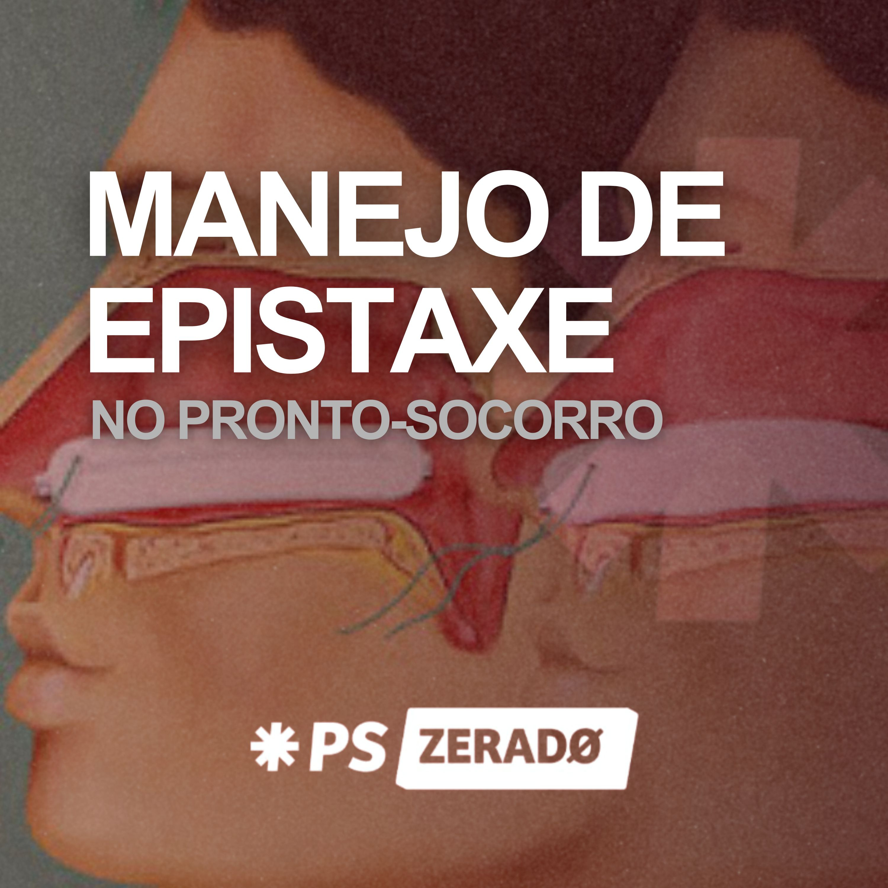 Tamponamento nasal sem Merocel, funciona?