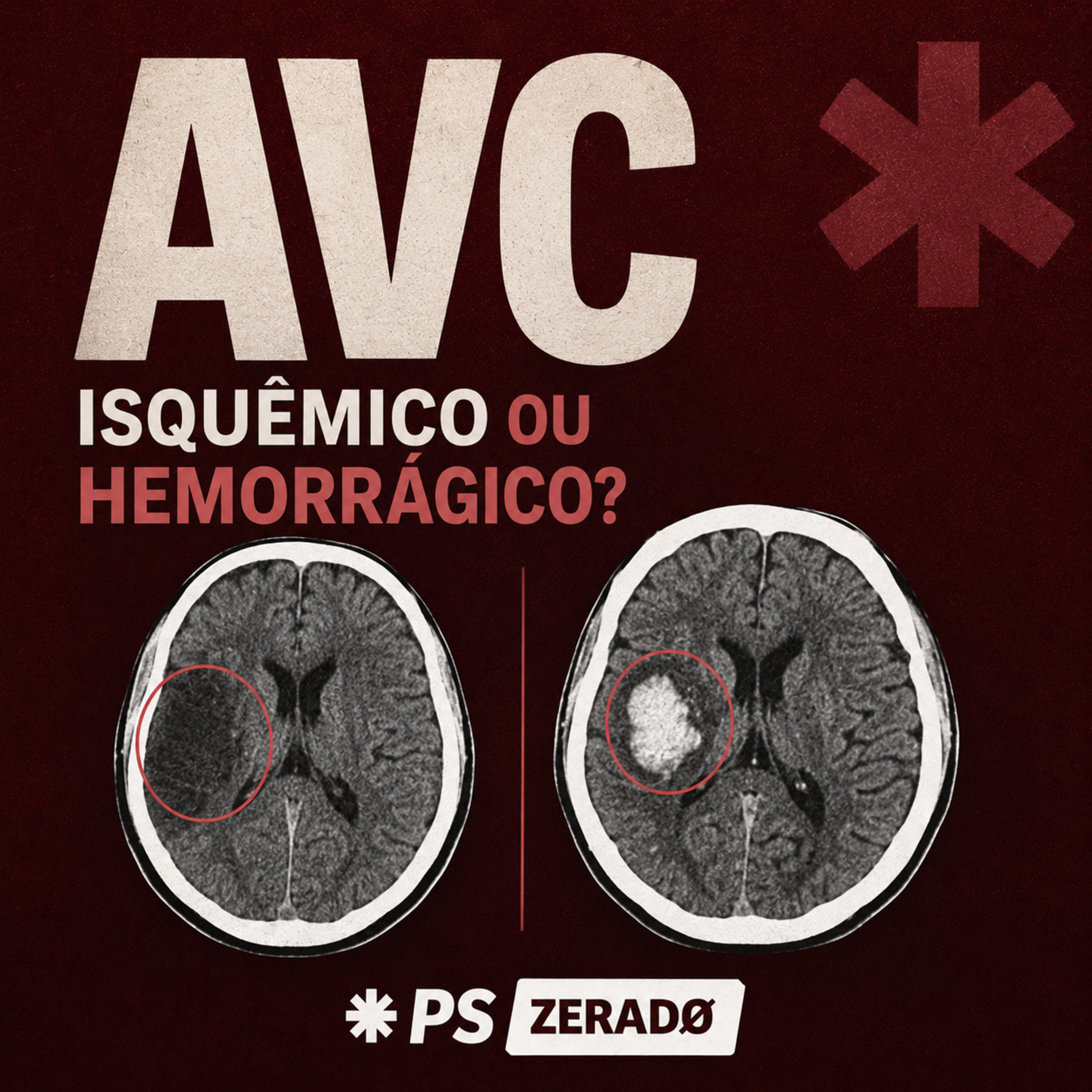 AVC: Do Diagnóstico à Trombólise  episode artwork
