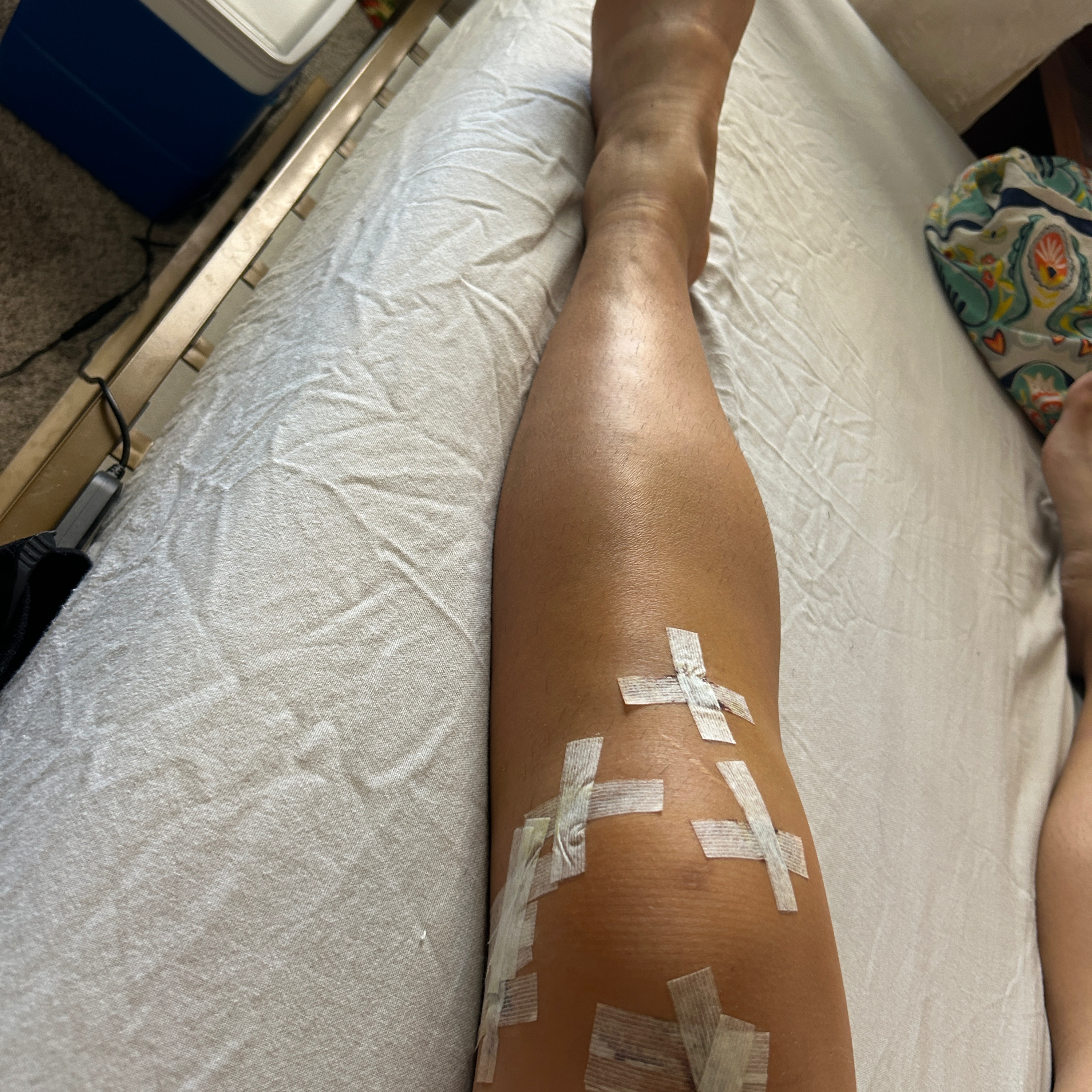 31. Week 3 of acl/meniscus surgery: almost half way to ditch crutches  episode artwork