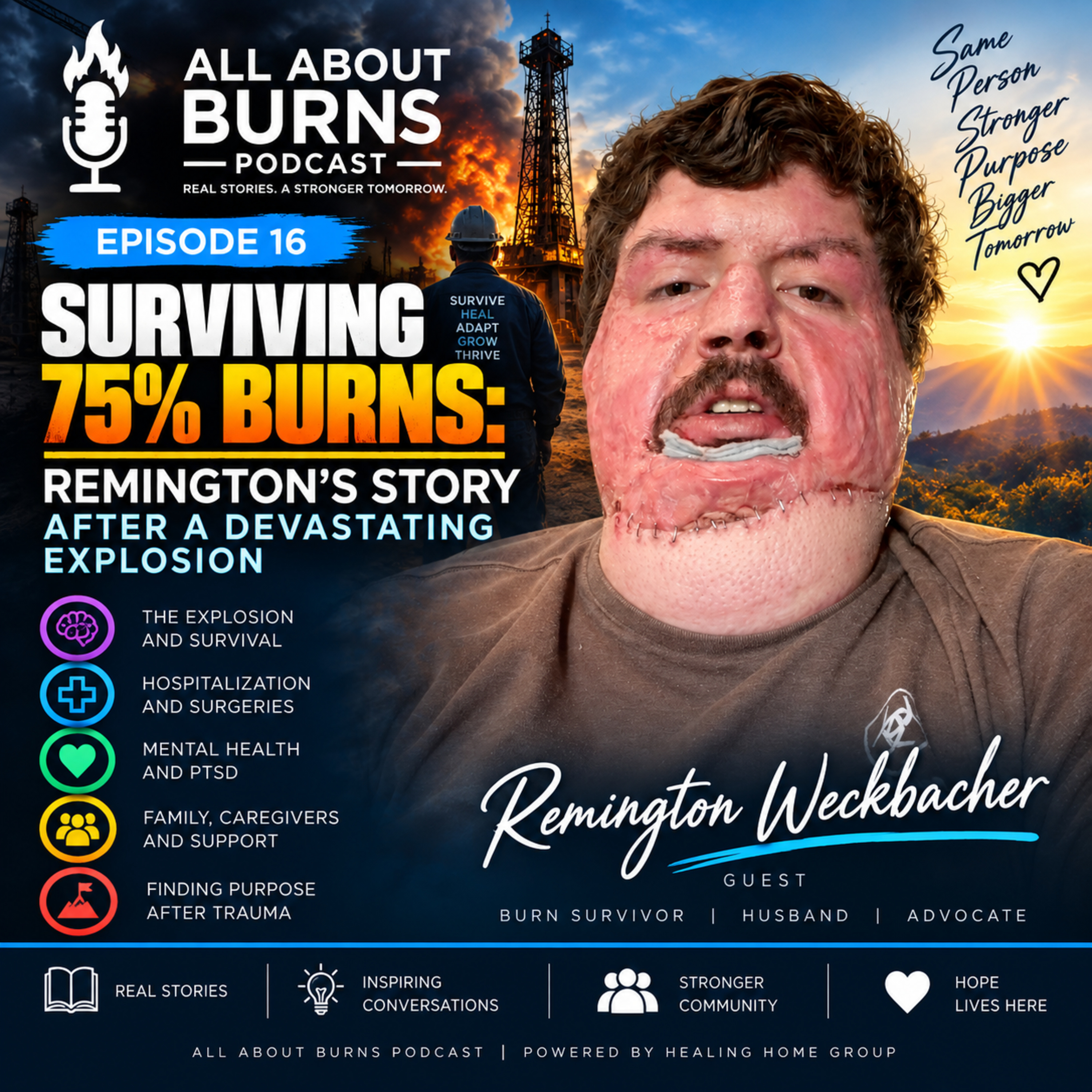 All About Burns