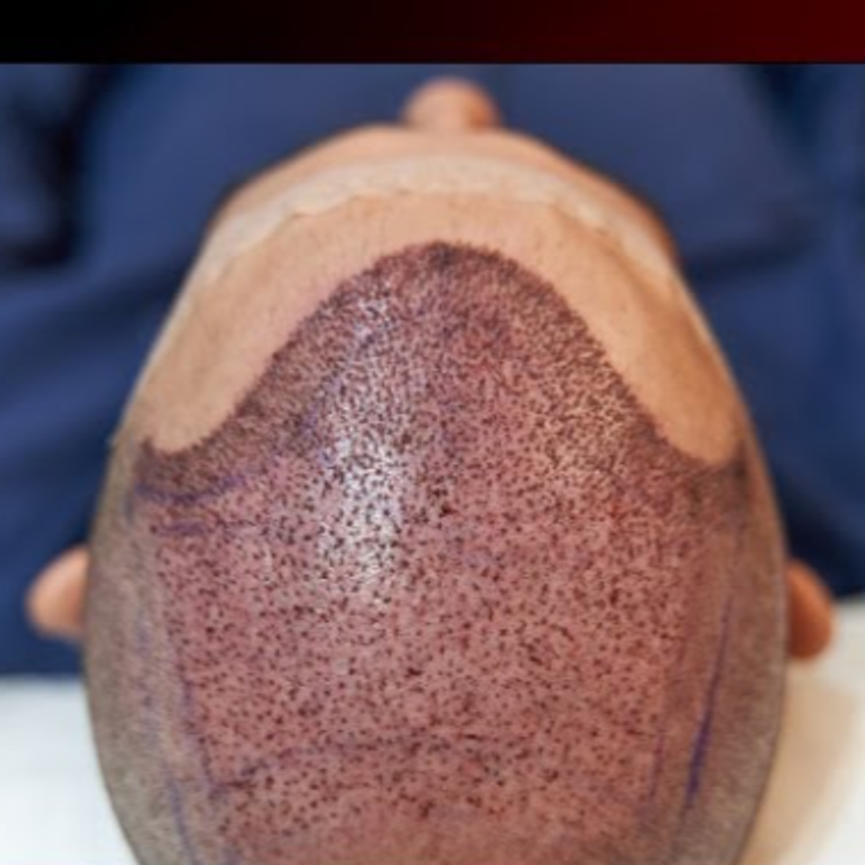 Will implanted hair feel normal or something foreign on the scalp when one touches them after hair transplant?