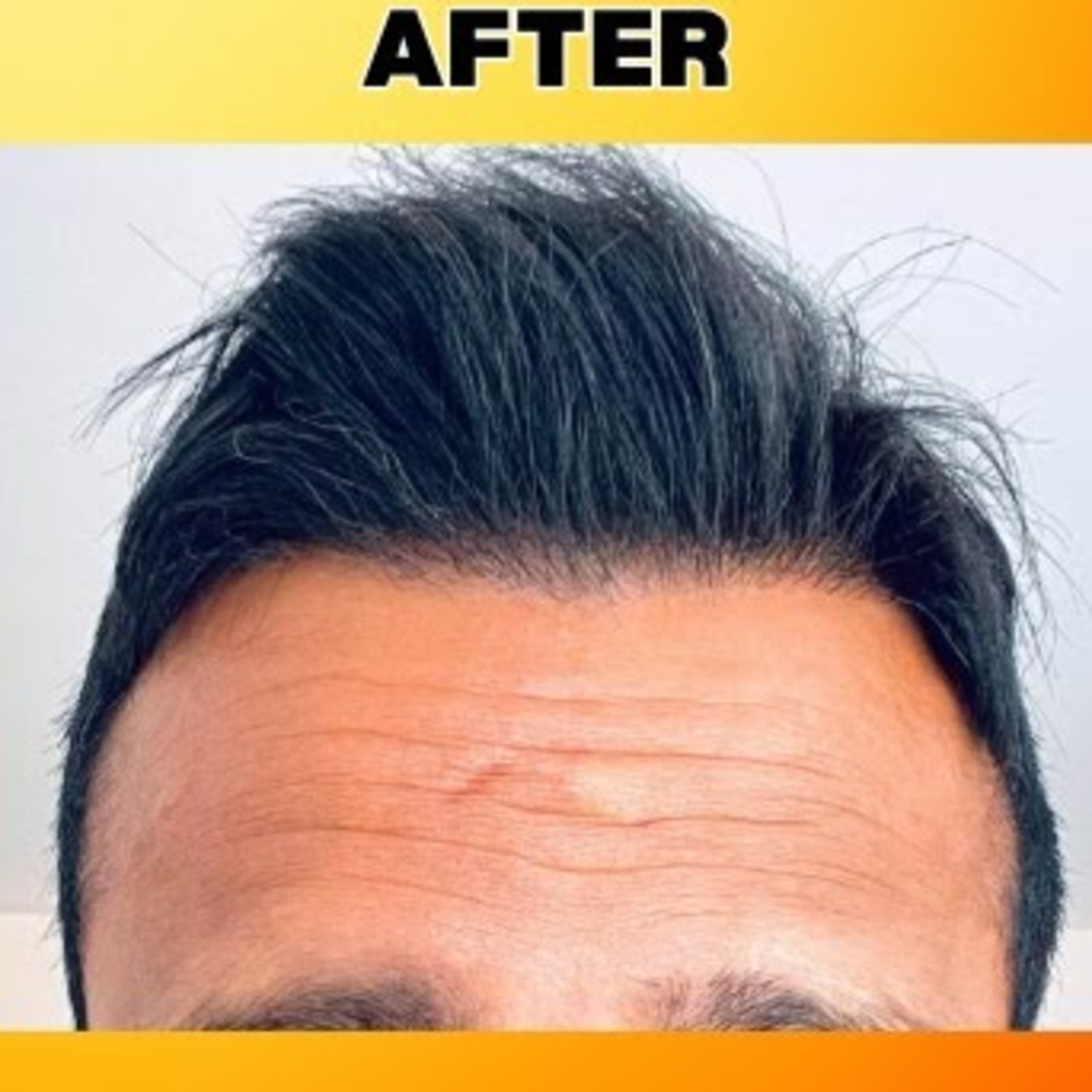 Can one look aged with a broad forehead? Can a hair transplant procedure make the hairline natural? What precautions one should take in such cases?