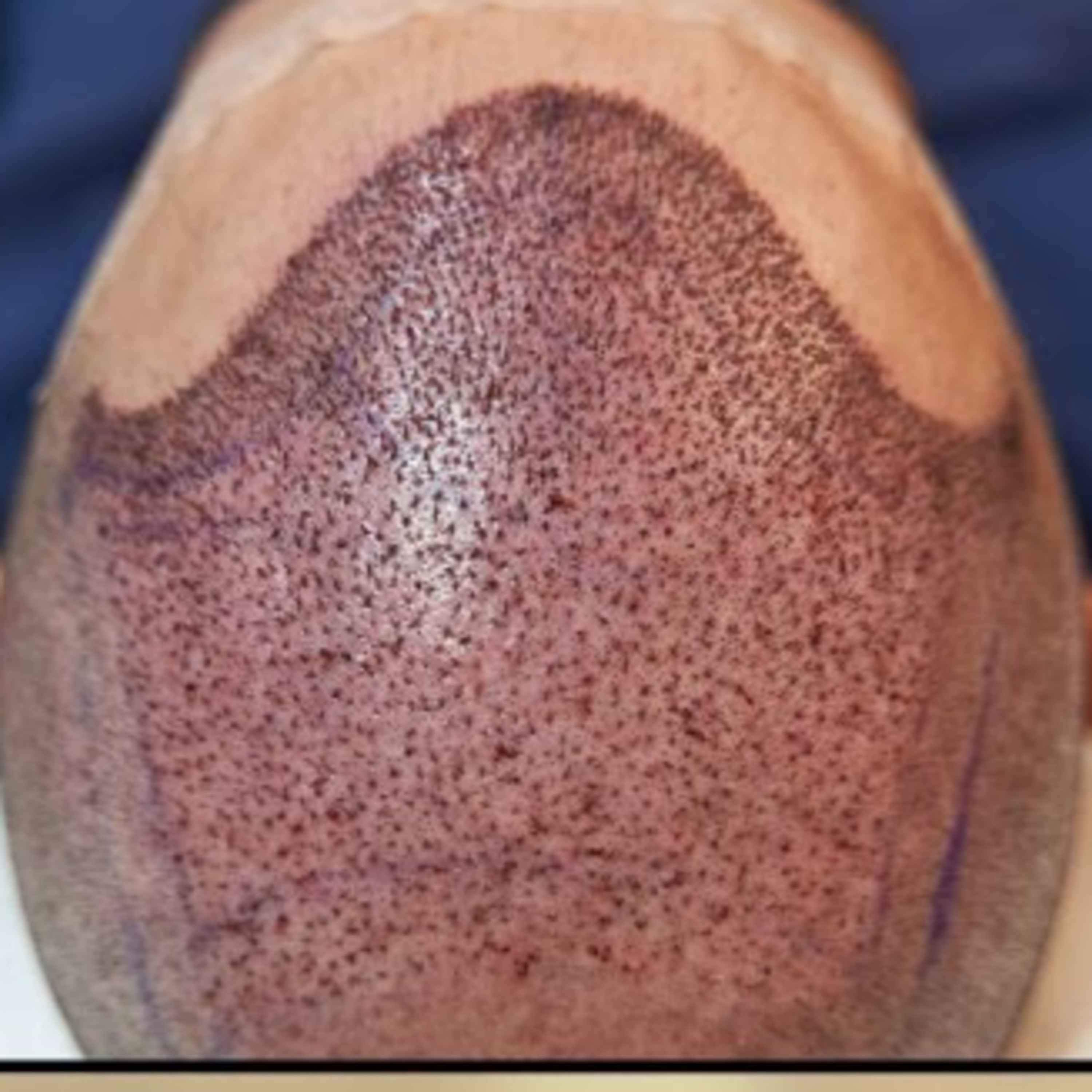 What are the potential risks and hidden costs associated with opting for a low-cost hair transplant, and why is it crucial to prioritize choosing a qualified surgeon over affordability?