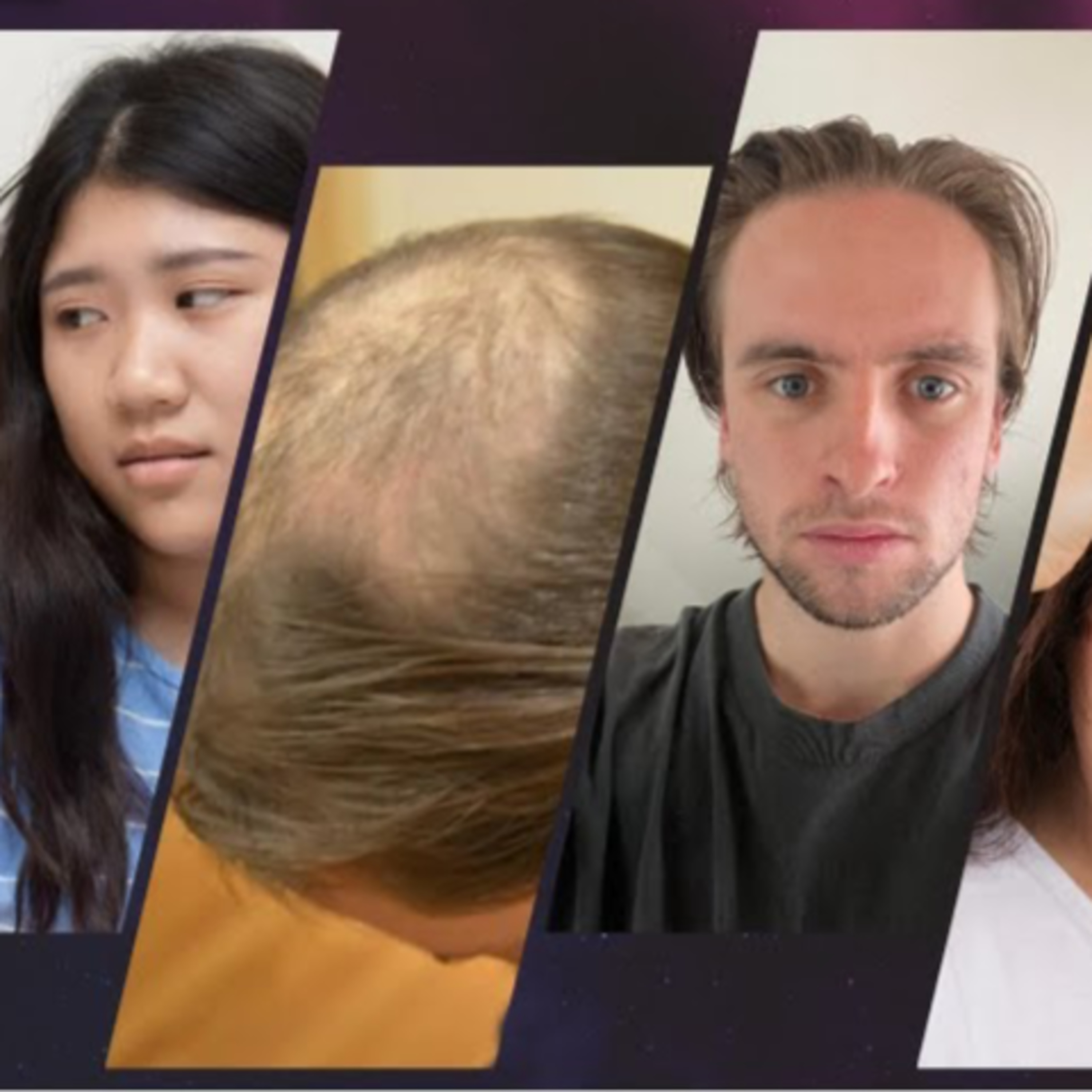 When does one qualify to opt for a hair transplant procedure? In what types of hair loss conditions, a hair transplant procedure is not advised?