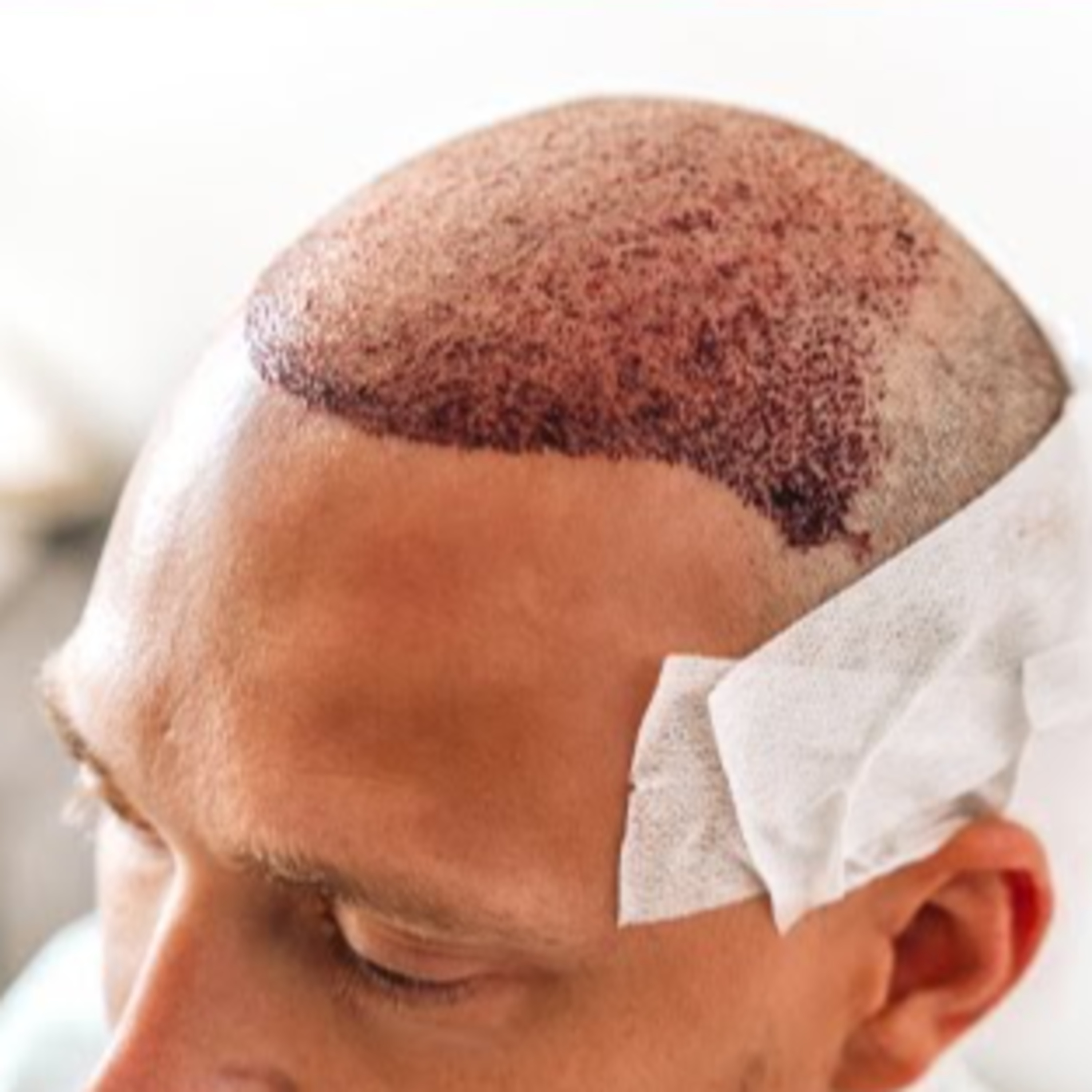 What is a repair hair transplant procedure and when does one need it?