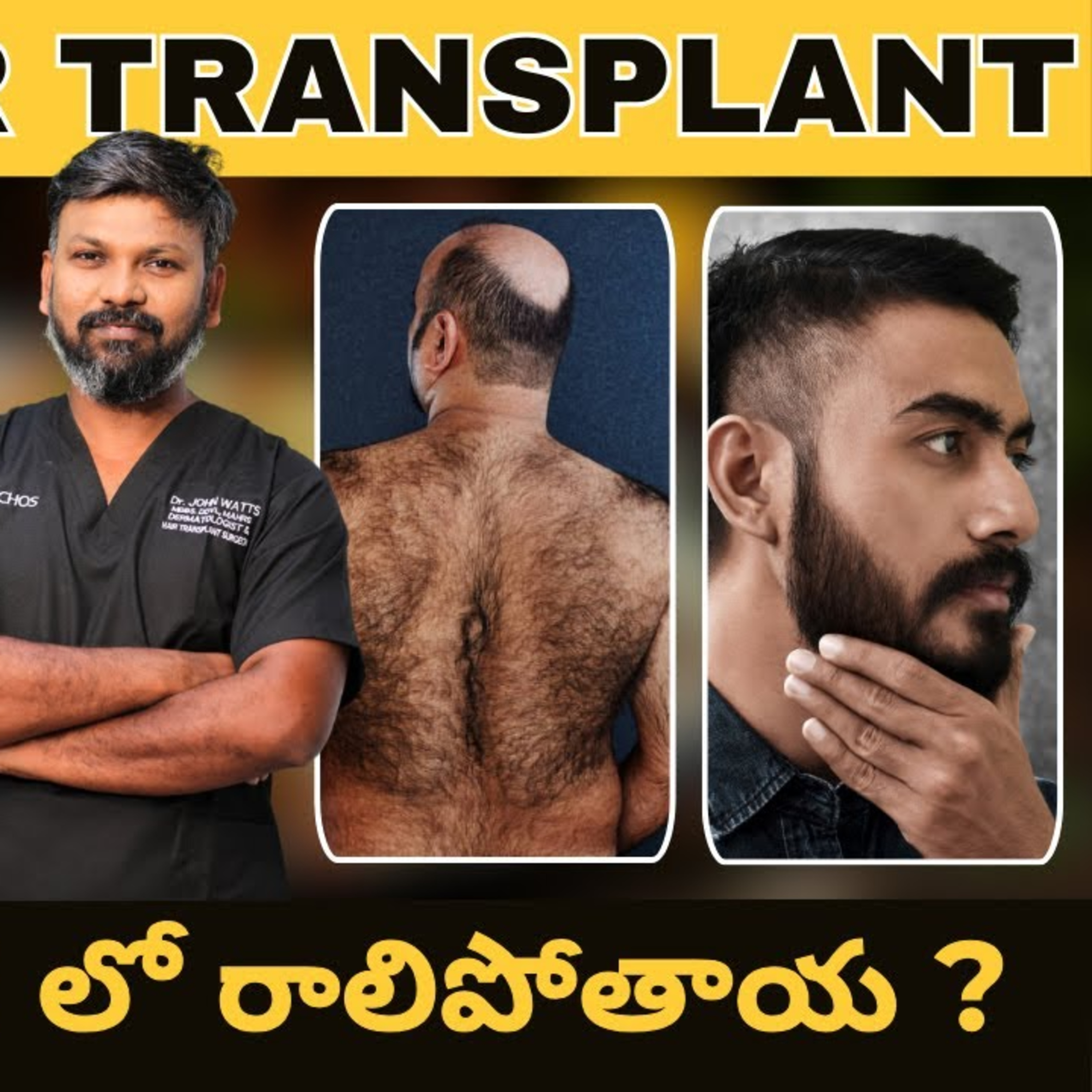 When implanted on the scalp, do they get miniaturised after a hair transplant and fall off? What is recipient dominance?