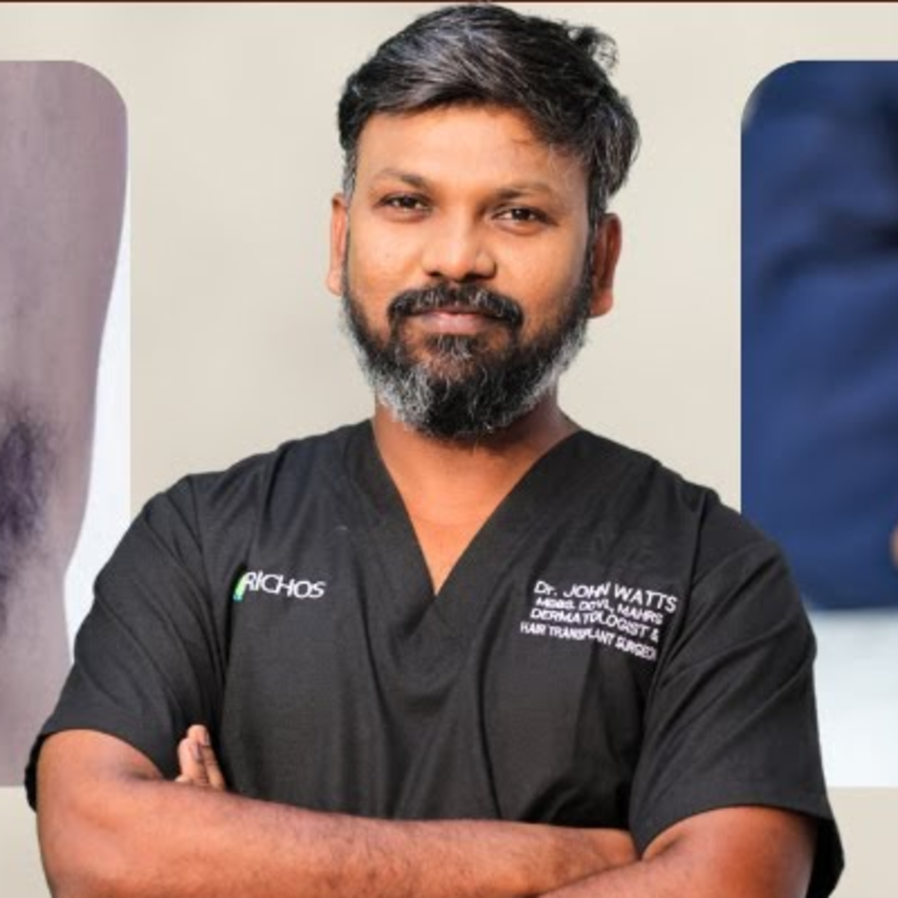 What are the disadvantages of using underarm hair as donor hair grafts for hair transplants?