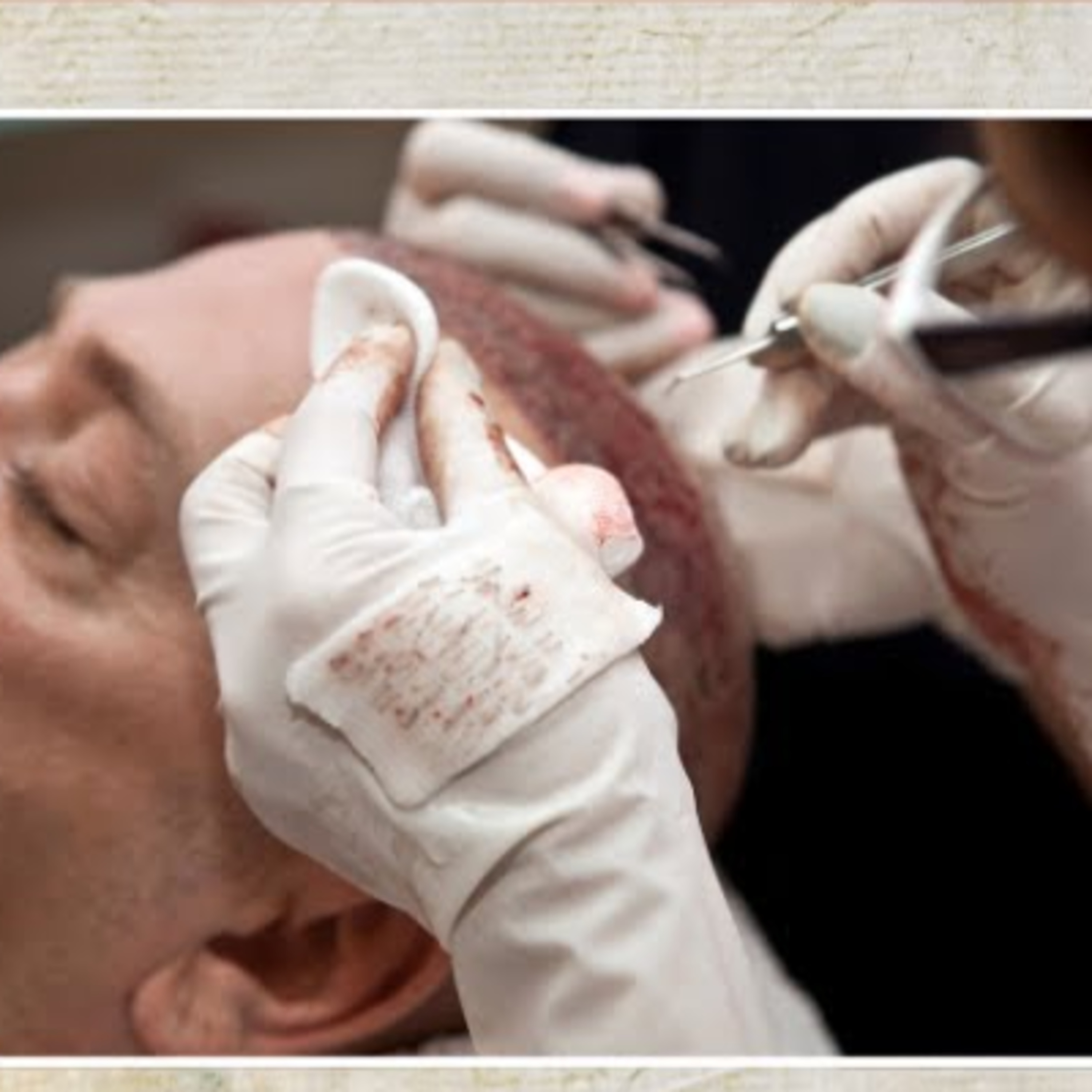 Does one need to get hospitalized for a hair transplant procedure? If yes, for how many days?