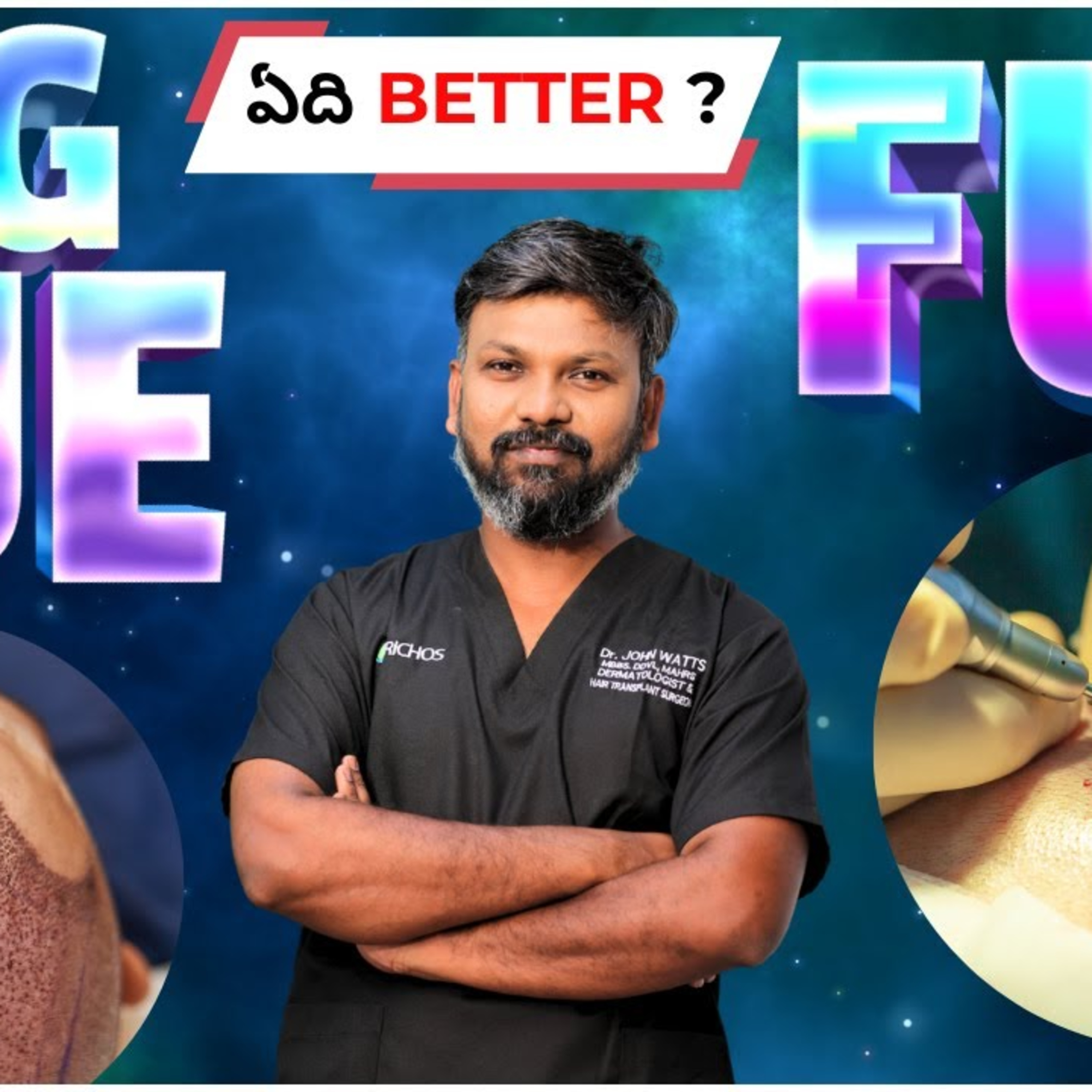 Is there any difference between a FUE hair transplant and a Big Hair Transplant?