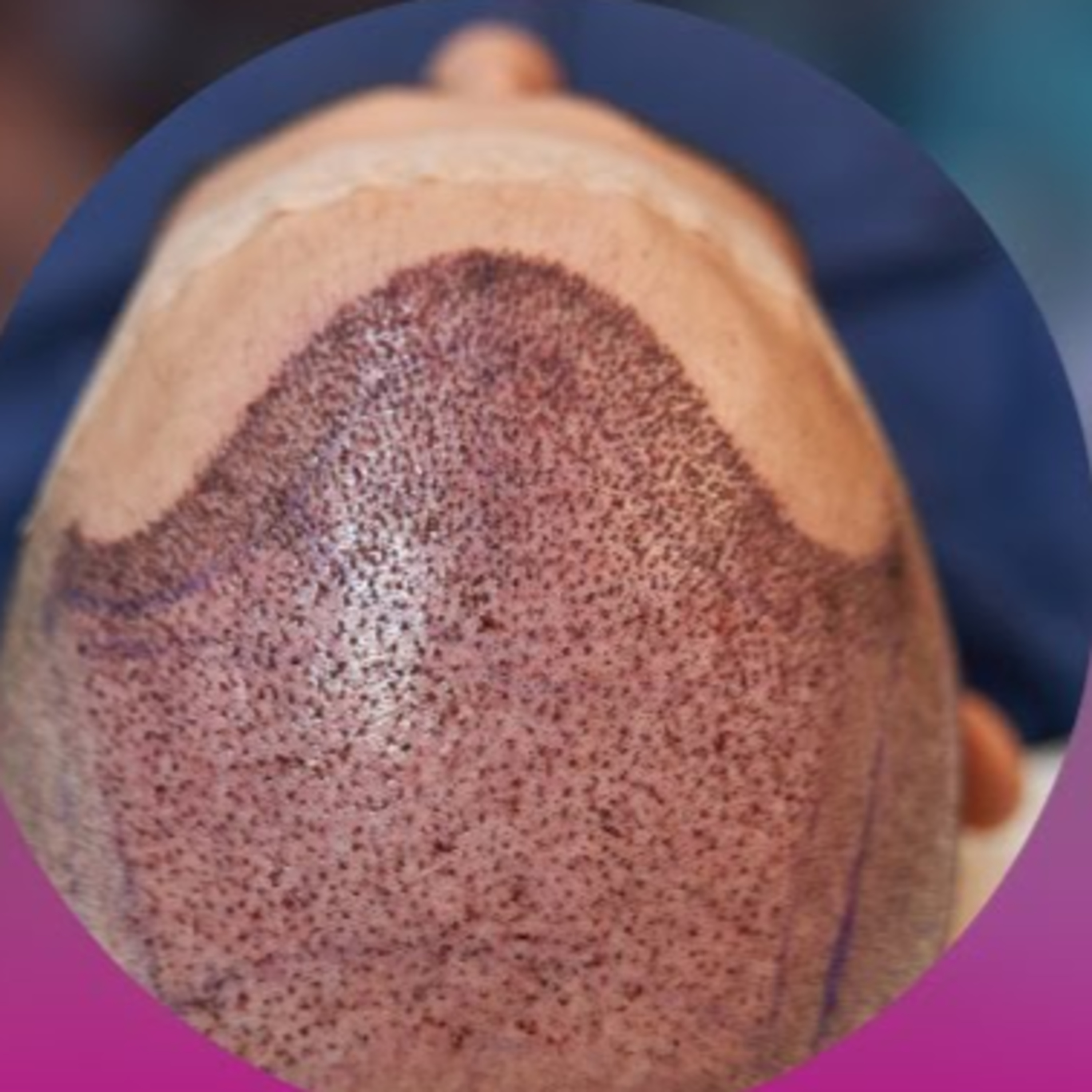 Is such hair fall permanent, or does it regrow? Does it happen with all hair transplant patients?