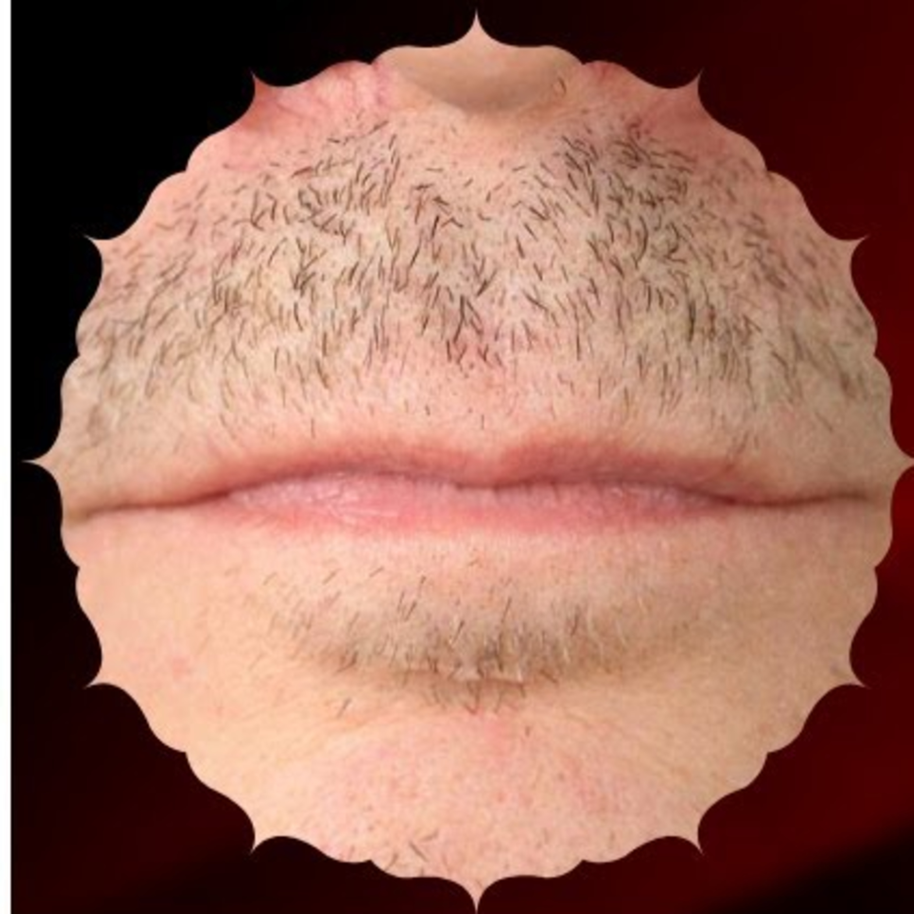What type of diagnostic tests need to be run to find out the cause of poor beard and moustache hair growth? Is hair transplant a solution?