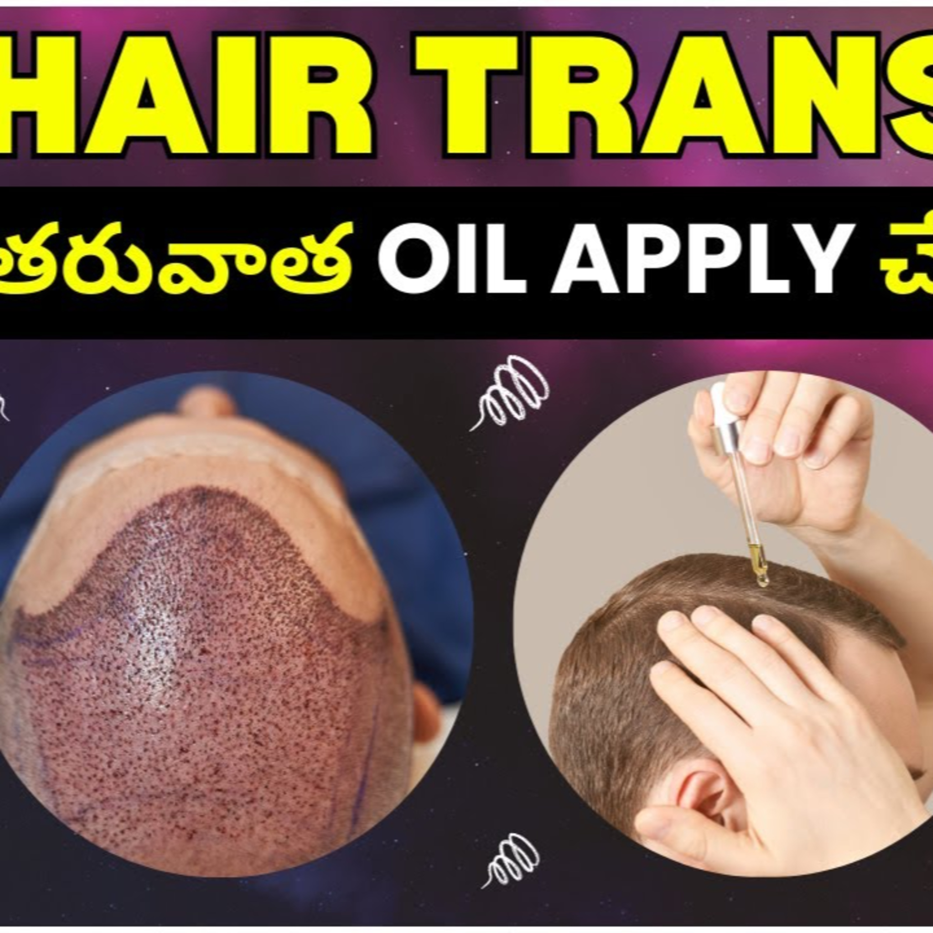 Can I use hair oil immediately after a hair transplant procedure?