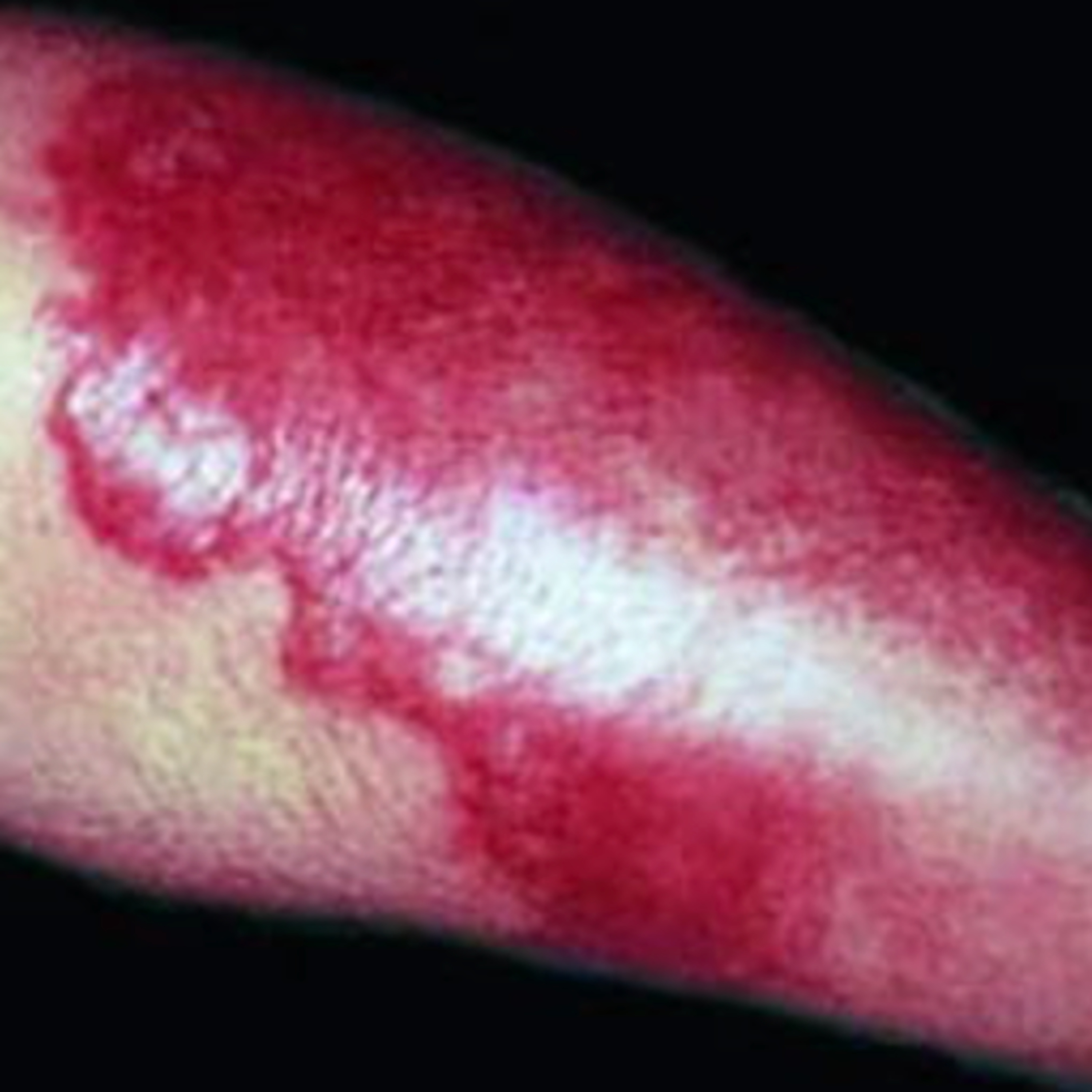 HY USMLE Q #730 – Dermatology