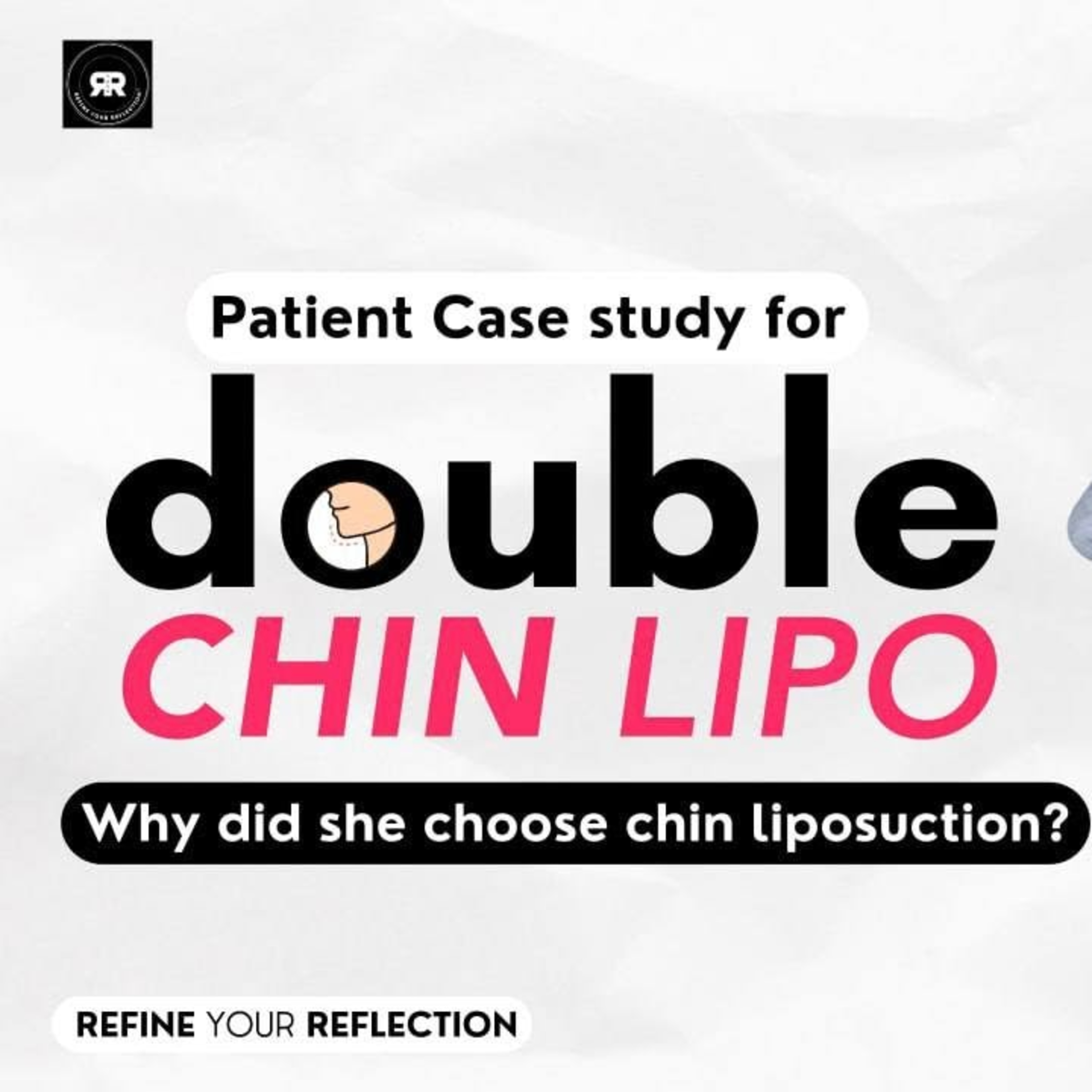 Double Chin Liposuction Case Study | Why She Chose Chin Lipo? (Before & After) episode artwork