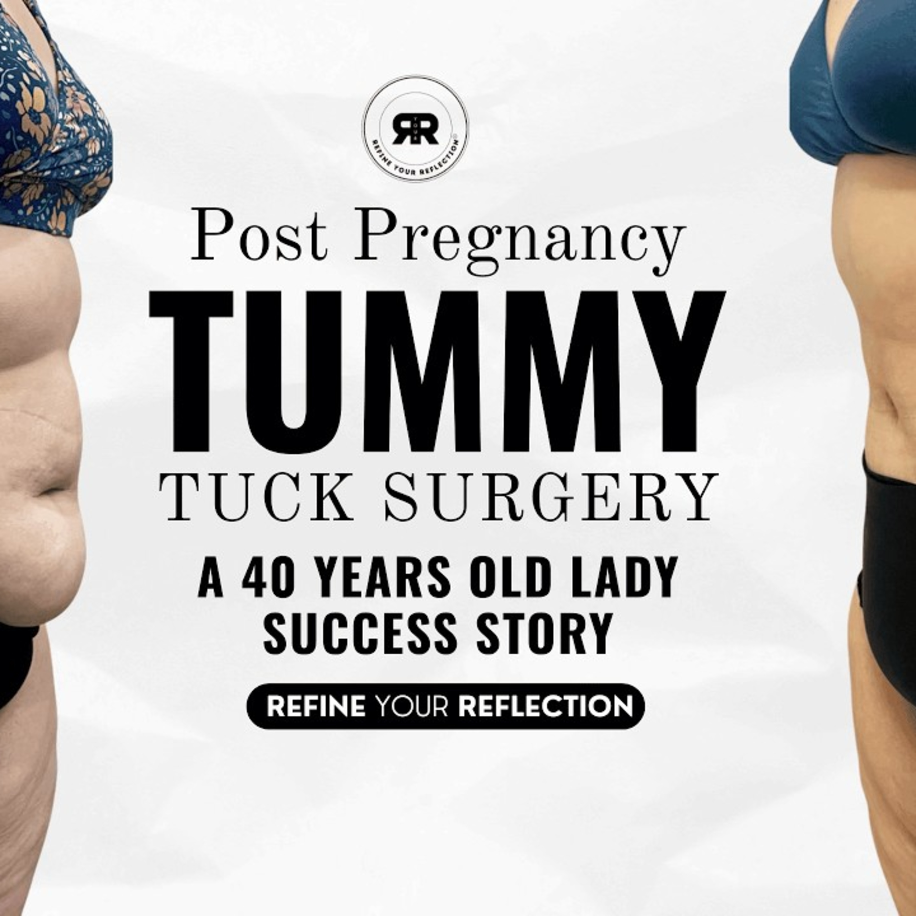 Post Pregnancy Tummy Tuck Transformation | 40-Year-Old Mom Success Story episode artwork