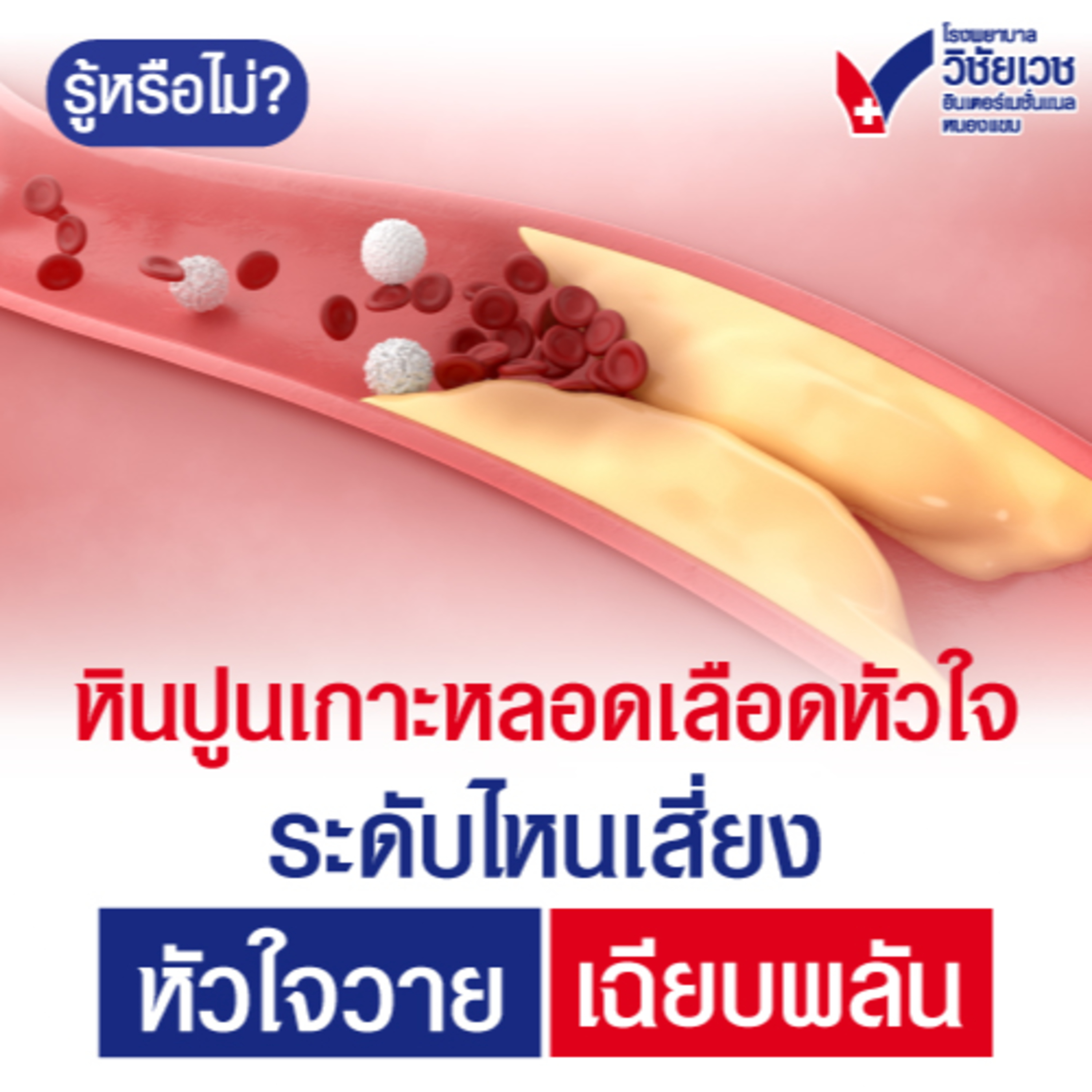 หินปูนเกาะหลอดเลือดหัวใจ ระดับไหนเสี่ยง หัวใจวายเฉียบพลัน