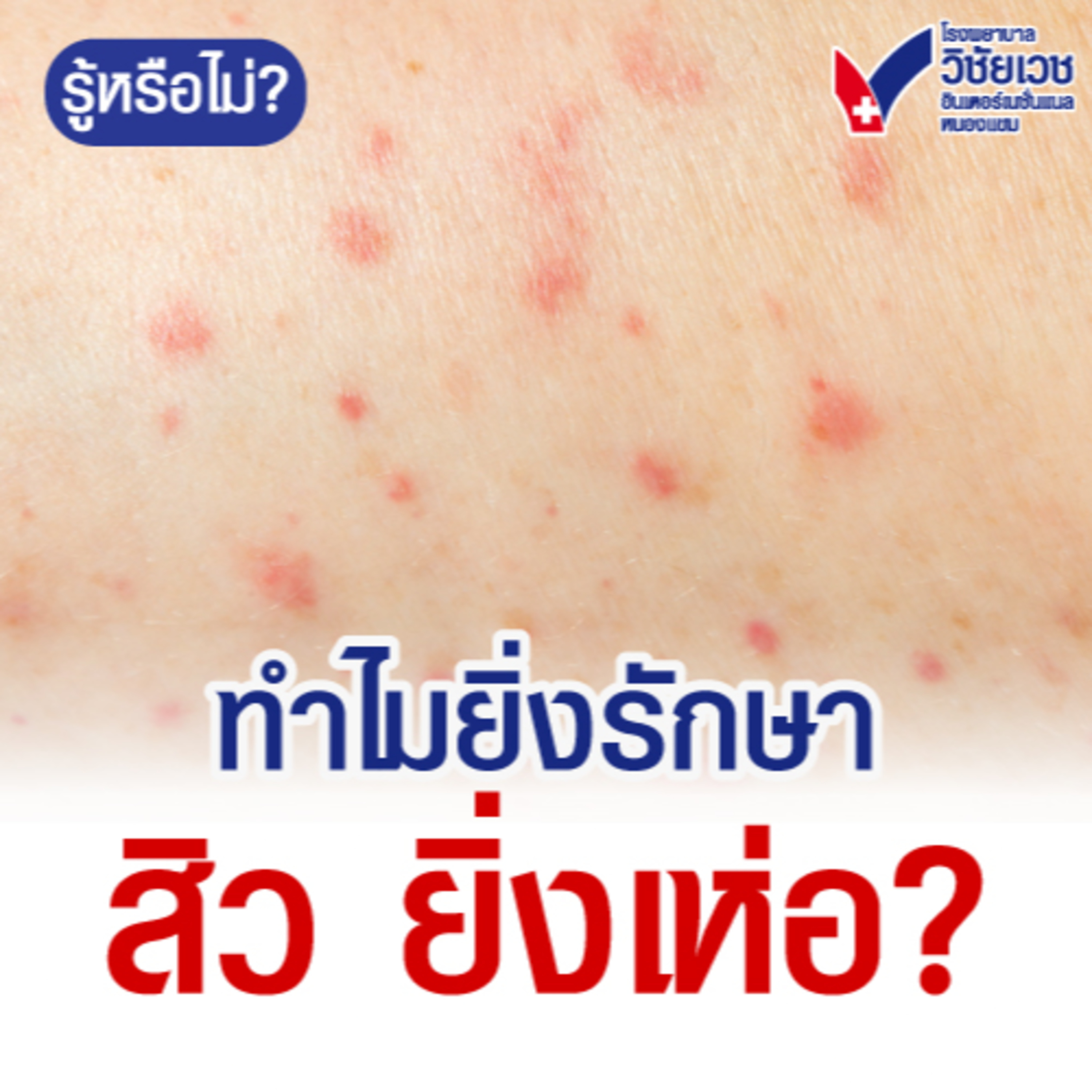 ทำไมยิ่งรักษาสิว ยิ่งเห่อ