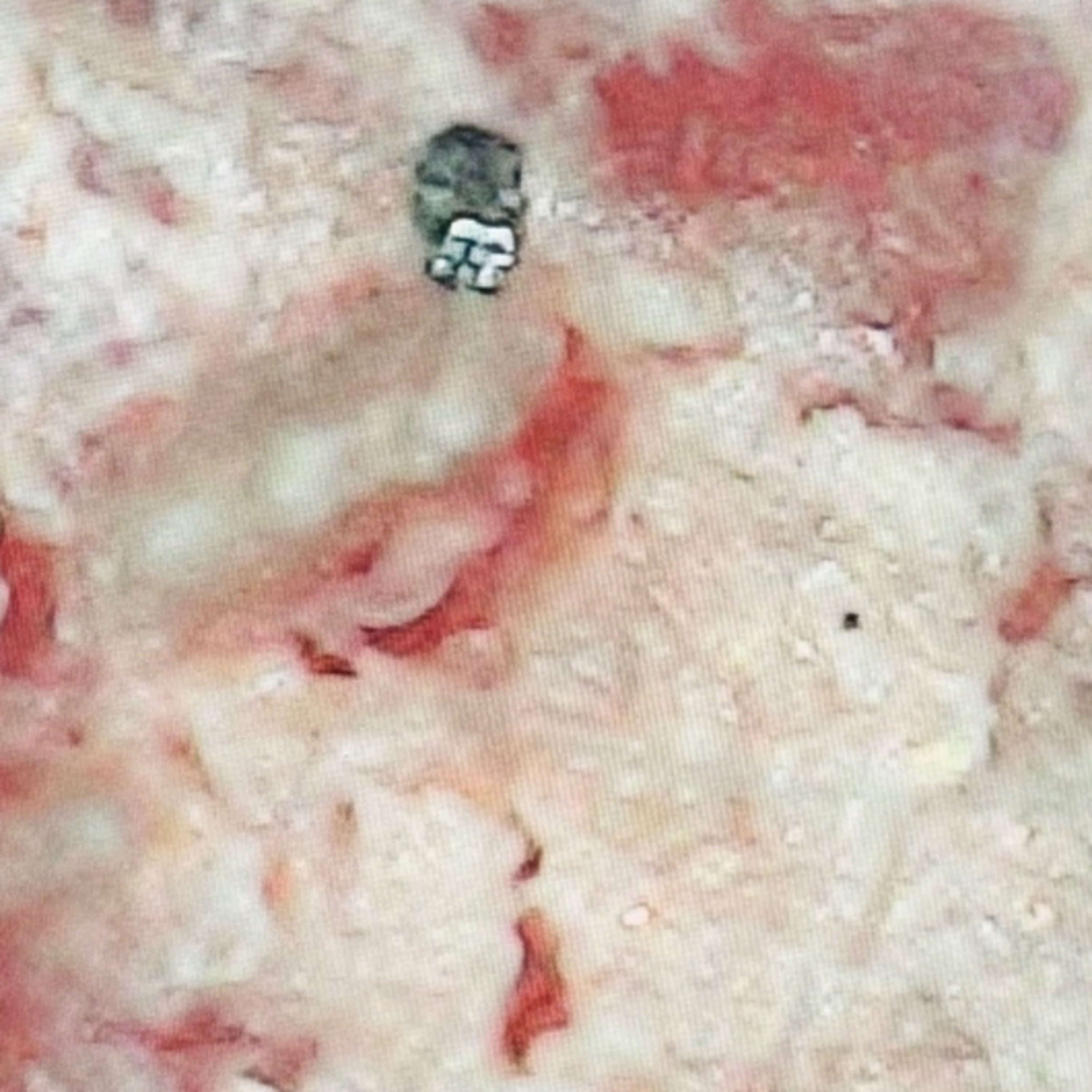 Morgellons: Pandora’s Matchbox