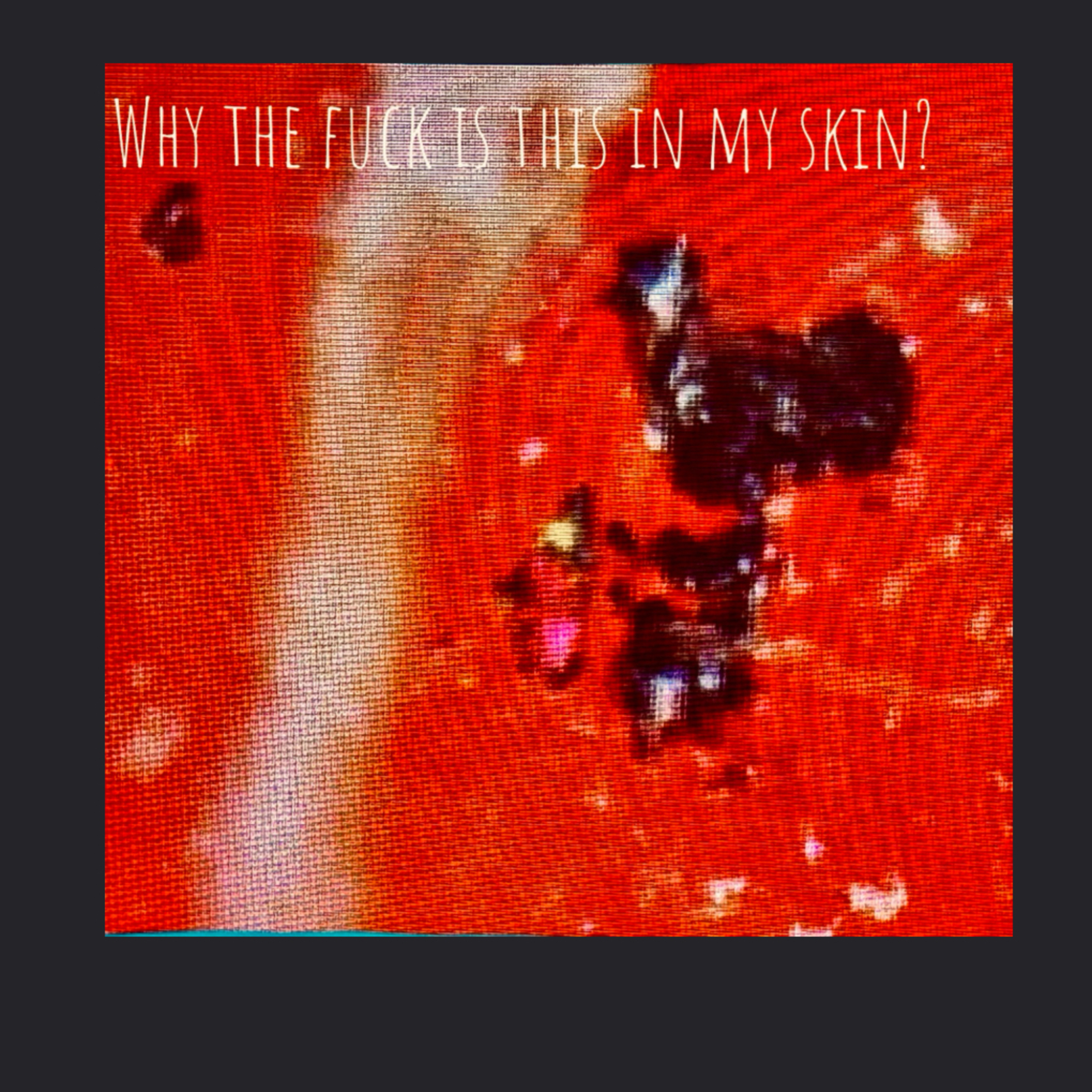 Morgellons: the P300 response